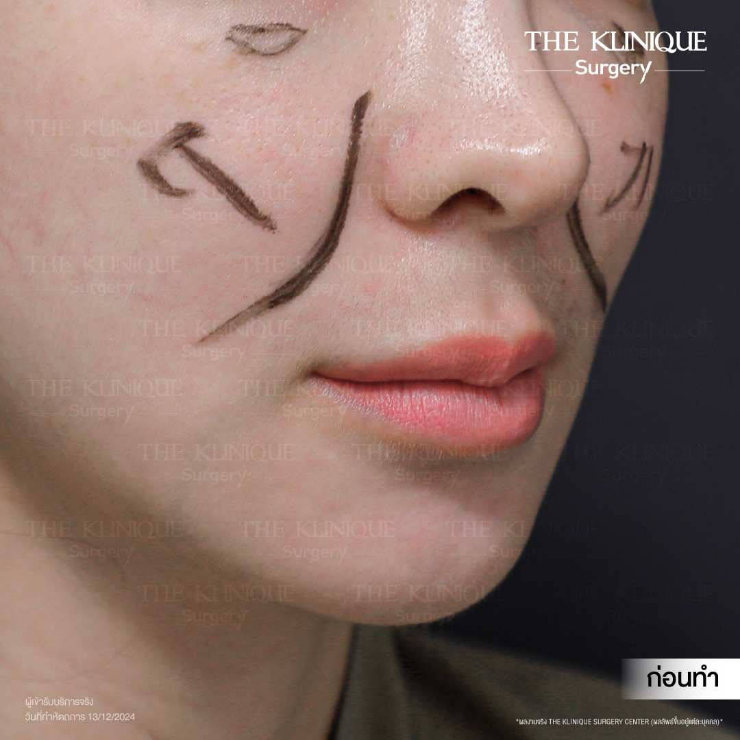 ศัลยกรรมดึงหน้า, ดึงหน้า, ดึงหน้าผาก, ดึงหน้าผาก ยกคิ้ว, Face Lock, Face Lift, ดึงหน้า ดึงคอ, ดึงหน้าย้อนวัย, ดึงหน้าดารา, Necklift, Face Lift คือ,Endotine หน้าผาก,ดึงหน้าผาก ยกคิ้ว, ศัลยกรรมดึงหน้าผาก, ดึงหน้าย้อนวัย, ศัลยกรรมยกคิ้ว, รีวิวศัลยกรรมยกคิ้ว, Endotine, Endotine รีวิว, ยกคิ้วส่องกล้อง, ผ่าตัดส่องกล้อง, ผ่าตัดดึงหน้า, Endotine รีวิว, ยกคิ้ว รีวิว, ยกคิ้วส่องกล้อง, ยกคิ้วส่องกล้อง รีวิว, ยกคิ้วที่ไหนดี