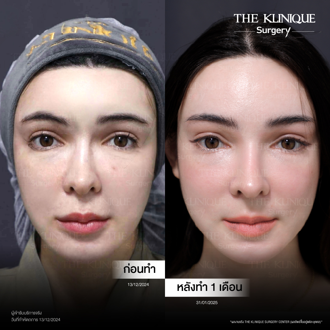 ศัลยกรรมดึงหน้า, ดึงหน้า, ดึงหน้าผาก, ดึงหน้าผาก ยกคิ้ว, Face Lock, Face Lift, ดึงหน้า ดึงคอ, ดึงหน้าย้อนวัย, ดึงหน้าดารา, Necklift, Face Lift คือ,Endotine หน้าผาก,ดึงหน้าผาก ยกคิ้ว, ศัลยกรรมดึงหน้าผาก, ดึงหน้าย้อนวัย, ศัลยกรรมยกคิ้ว, รีวิวศัลยกรรมยกคิ้ว, Endotine, Endotine รีวิว, ยกคิ้วส่องกล้อง, ผ่าตัดส่องกล้อง, ผ่าตัดดึงหน้า, Endotine รีวิว, ยกคิ้ว รีวิว, ยกคิ้วส่องกล้อง, ยกคิ้วส่องกล้อง รีวิว, ยกคิ้วที่ไหนดี