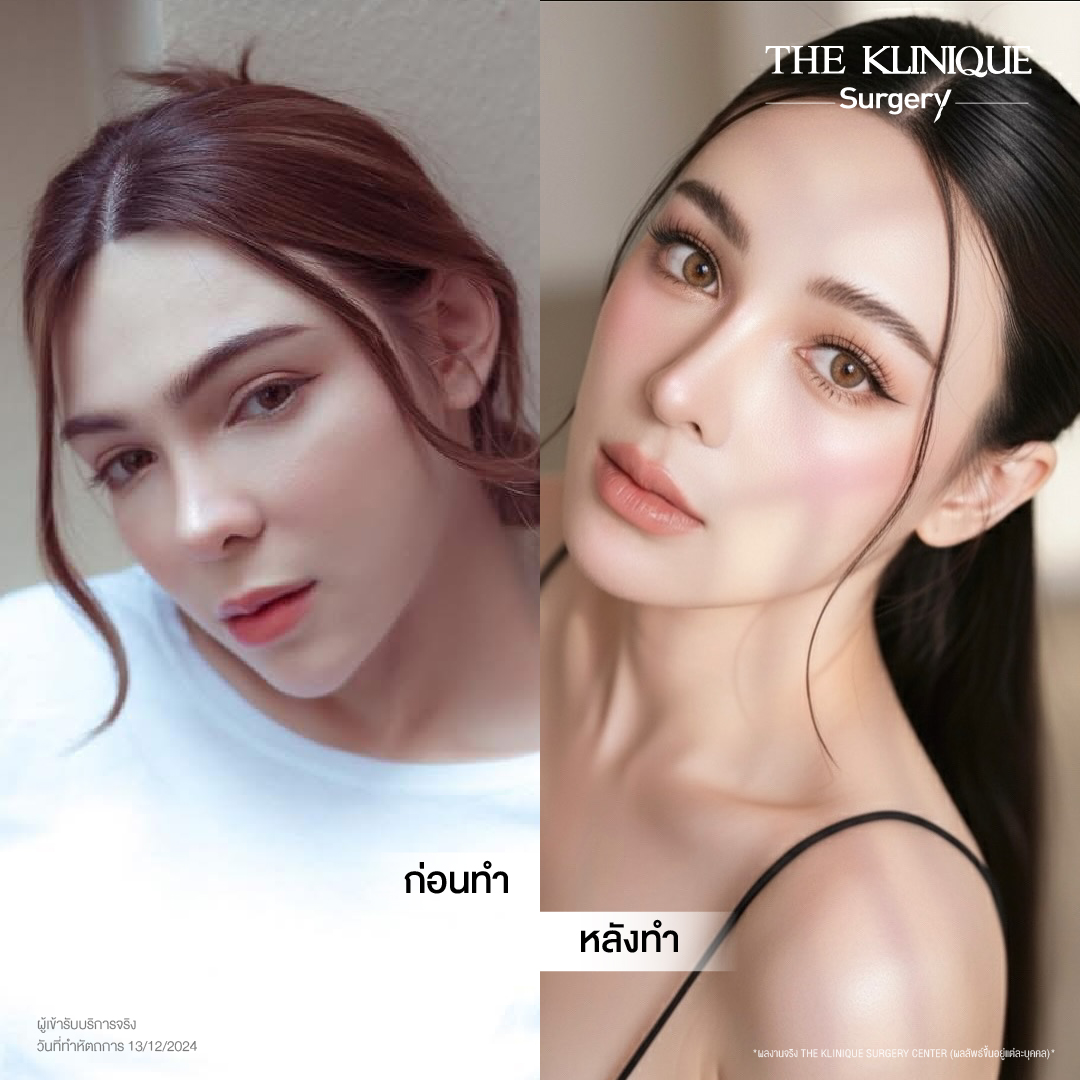 ศัลยกรรมดึงหน้า, ดึงหน้า, ดึงหน้าผาก, ดึงหน้าผาก ยกคิ้ว, Face Lock, Face Lift, ดึงหน้า ดึงคอ, ดึงหน้าย้อนวัย, ดึงหน้าดารา, Necklift, Face Lift คือ,Endotine หน้าผาก,ดึงหน้าผาก ยกคิ้ว, ศัลยกรรมดึงหน้าผาก, ดึงหน้าย้อนวัย, ศัลยกรรมยกคิ้ว, รีวิวศัลยกรรมยกคิ้ว, Endotine, Endotine รีวิว, ยกคิ้วส่องกล้อง, ผ่าตัดส่องกล้อง, ผ่าตัดดึงหน้า, Endotine รีวิว, ยกคิ้ว รีวิว, ยกคิ้วส่องกล้อง, ยกคิ้วส่องกล้อง รีวิว, ยกคิ้วที่ไหนดี