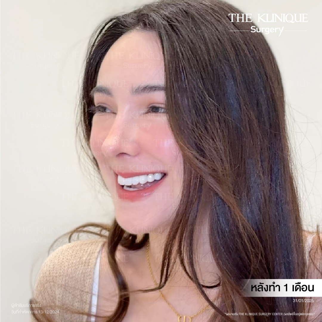 ศัลยกรรมดึงหน้า, ดึงหน้า, ดึงหน้าผาก, ดึงหน้าผาก ยกคิ้ว, Face Lock, Face Lift, ดึงหน้า ดึงคอ, ดึงหน้าย้อนวัย, ดึงหน้าดารา, Necklift, Face Lift คือ,Endotine หน้าผาก,ดึงหน้าผาก ยกคิ้ว, ศัลยกรรมดึงหน้าผาก, ดึงหน้าย้อนวัย, ศัลยกรรมยกคิ้ว, รีวิวศัลยกรรมยกคิ้ว, Endotine, Endotine รีวิว, ยกคิ้วส่องกล้อง, ผ่าตัดส่องกล้อง, ผ่าตัดดึงหน้า, Endotine รีวิว, ยกคิ้ว รีวิว, ยกคิ้วส่องกล้อง, ยกคิ้วส่องกล้อง รีวิว, ยกคิ้วที่ไหนดี