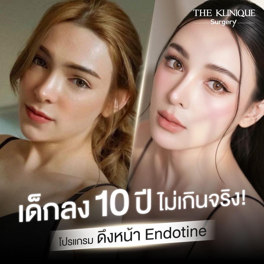 ศัลยกรรมดึงหน้า, ดึงหน้า, ดึงหน้าผาก, ดึงหน้าผาก ยกคิ้ว, Face Lock, Face Lift, ดึงหน้า ดึงคอ, ดึงหน้าย้อนวัย, ดึงหน้าดารา, Necklift, Face Lift คือ,Endotine หน้าผาก,ดึงหน้าผาก ยกคิ้ว, ศัลยกรรมดึงหน้าผาก, ดึงหน้าย้อนวัย, ศัลยกรรมยกคิ้ว, รีวิวศัลยกรรมยกคิ้ว, Endotine, Endotine รีวิว, ยกคิ้วส่องกล้อง, ผ่าตัดส่องกล้อง, ผ่าตัดดึงหน้า, Endotine รีวิว, ยกคิ้ว รีวิว, ยกคิ้วส่องกล้อง, ยกคิ้วส่องกล้อง รีวิว, ยกคิ้วที่ไหนดี