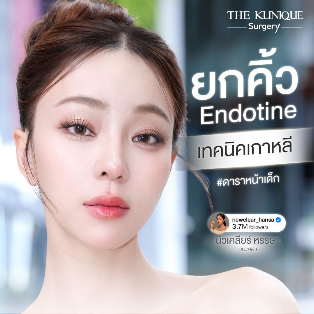 รีวิวสุดจึ้ง Endotine + Mini Facelift ดึงหน้า ยกคิ้ว เทคนิคเกาหลี ครบ 1 ปี