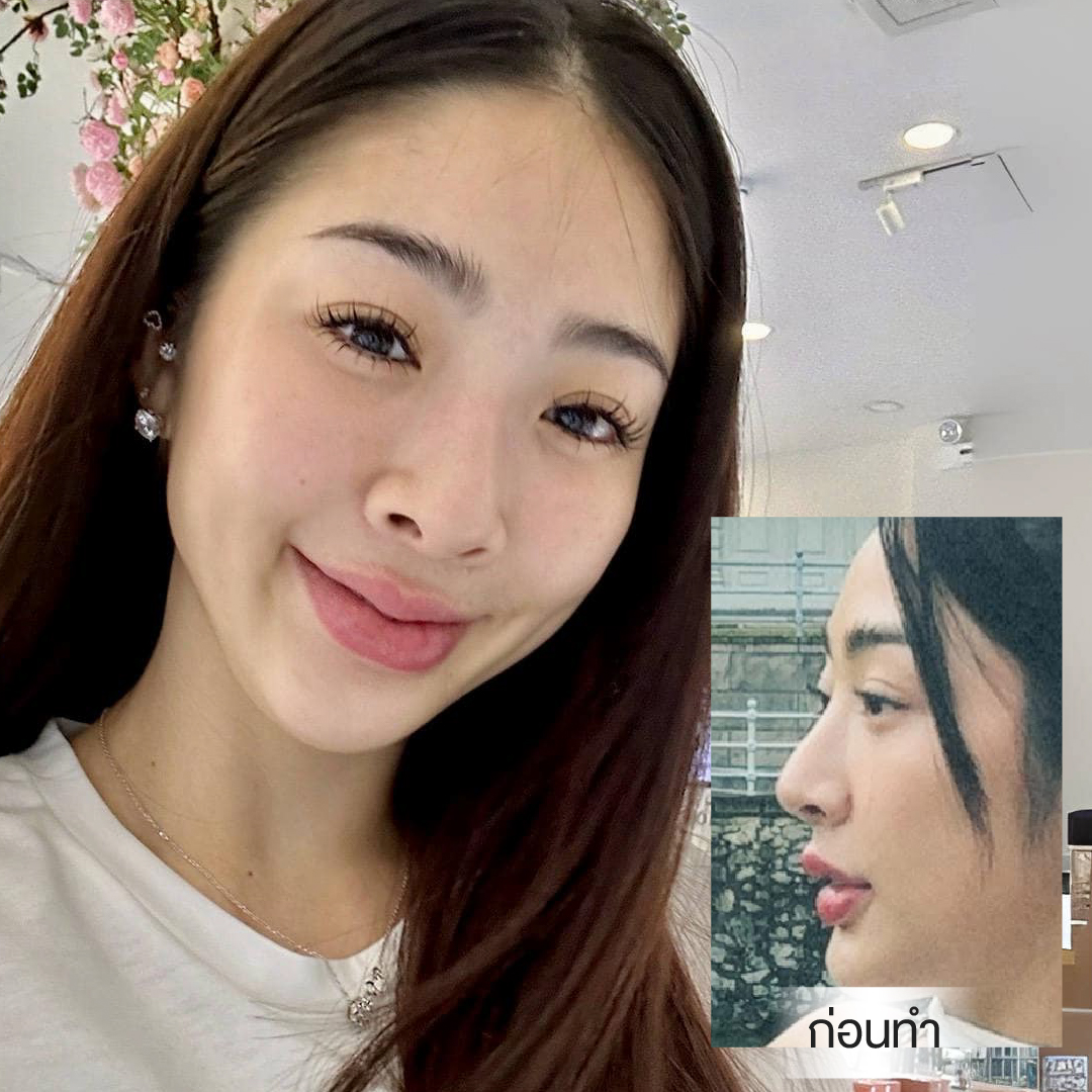 ศัลยกรรมจมูก, ศัลยกรรมจมูก รีวิว, เสริมจมูก, รีวิวเสริมจมูก, ทำจมูก, ทำจมูก รีวิว, ทำจมูกแบบ Open, ซิลิโคนจมูก, จมูก Open, เสริมจมูกโอเพ่น, เสริมจมูกOpen ที่ไหนดี,  เสริมจมูกโอเพ่น  ที่ไหนดี,  เสริมจมูกโอเพ่น Open คือ, รีวิวเสริมจมูกโอเพ่น Open, ทรงจมูก, ทรงจมูกสวย, ทรงจมูกธรรมชาติ, ทรงจมูกสโลปปลายพุ่ง,ทรงจมูก,จมูก พส, จีน พส จีน