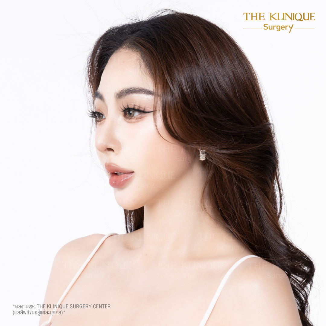 ศัลยกรรมจมูก, ศัลยกรรมจมูก รีวิว, เสริมจมูก, รีวิวเสริมจมูก, ทำจมูก, ทำจมูก รีวิว, ทำจมูกแบบ Open, ซิลิโคนจมูก, จมูก Open, เสริมจมูกโอเพ่น, เสริมจมูกOpen ที่ไหนดี, เสริมจมูกโอเพ่น ที่ไหนดี, เสริมจมูกโอเพ่น Open คือ, รีวิวเสริมจมูกโอเพ่น Open, ทรงจมูก, ทรงจมูกสวย, ทรงจมูกธรรมชาติ, ทรงจมูกสโลปปลายพุ่ง,ทรงจมูก,จมูก พส, จีน พส จีน