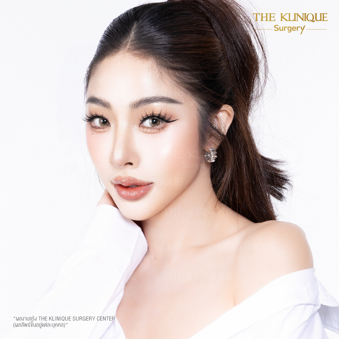 ศัลยกรรมจมูก, ศัลยกรรมจมูก รีวิว, เสริมจมูก, รีวิวเสริมจมูก, ทำจมูก, ทำจมูก รีวิว, ทำจมูกแบบ Open, ซิลิโคนจมูก, จมูก Open, เสริมจมูกโอเพ่น, เสริมจมูกOpen ที่ไหนดี, เสริมจมูกโอเพ่น ที่ไหนดี, เสริมจมูกโอเพ่น Open คือ, รีวิวเสริมจมูกโอเพ่น Open, ทรงจมูก, ทรงจมูกสวย, ทรงจมูกธรรมชาติ, ทรงจมูกสโลปปลายพุ่ง,ทรงจมูก,จมูก พส, จีน พส จีน