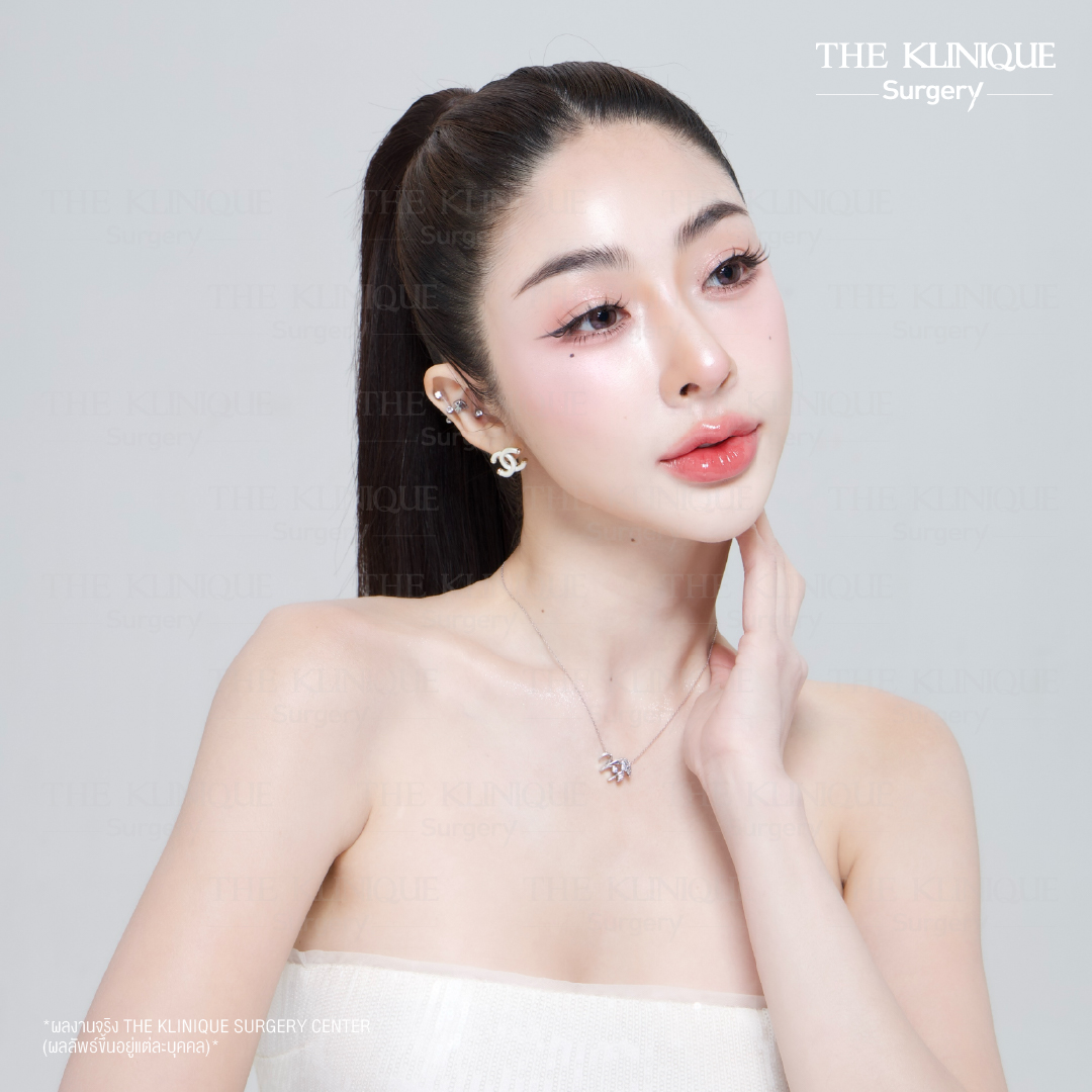 ศัลยกรรมจมูก, ศัลยกรรมจมูก รีวิว, เสริมจมูก, รีวิวเสริมจมูก, ทำจมูก, ทำจมูก รีวิว, ทำจมูกแบบ Open, ซิลิโคนจมูก, จมูก Open, เสริมจมูกโอเพ่น, เสริมจมูกOpen ที่ไหนดี, เสริมจมูกโอเพ่น ที่ไหนดี, เสริมจมูกโอเพ่น Open คือ, รีวิวเสริมจมูกโอเพ่น Open, ทรงจมูก, ทรงจมูกสวย, ทรงจมูกธรรมชาติ, ทรงจมูกสโลปปลายพุ่ง,ทรงจมูก,จมูก พส, จีน พส จีน