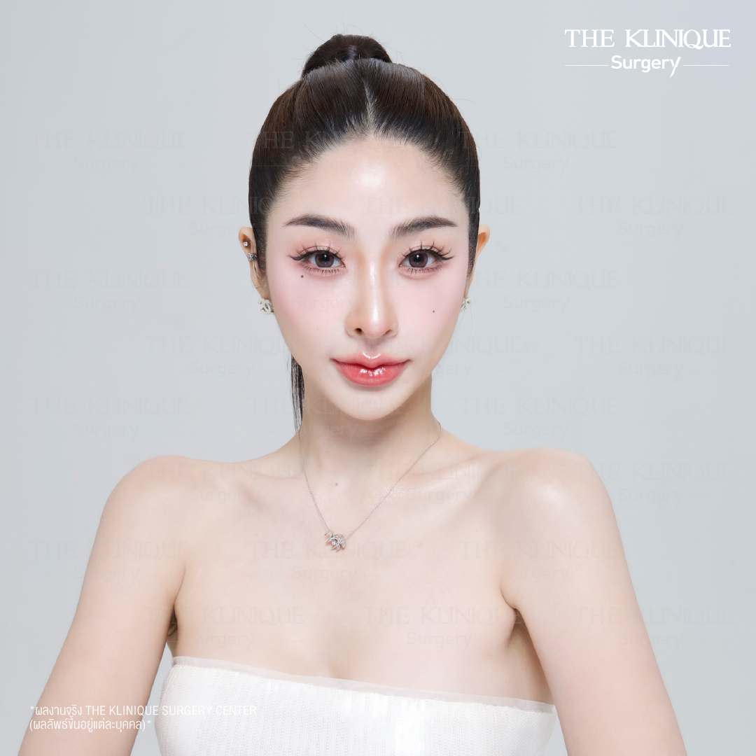 ศัลยกรรมจมูก, ศัลยกรรมจมูก รีวิว, เสริมจมูก, รีวิวเสริมจมูก, ทำจมูก, ทำจมูก รีวิว, ทำจมูกแบบ Open, ซิลิโคนจมูก, จมูก Open, เสริมจมูกโอเพ่น, เสริมจมูกOpen ที่ไหนดี, เสริมจมูกโอเพ่น ที่ไหนดี, เสริมจมูกโอเพ่น Open คือ, รีวิวเสริมจมูกโอเพ่น Open, ทรงจมูก, ทรงจมูกสวย, ทรงจมูกธรรมชาติ, ทรงจมูกสโลปปลายพุ่ง,ทรงจมูก,จมูก พส, จีน พส จีน