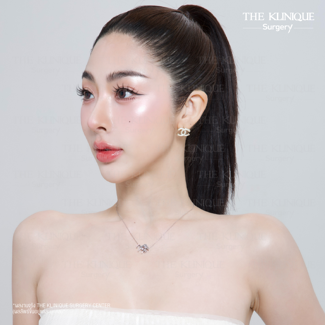 ศัลยกรรมจมูก, ศัลยกรรมจมูก รีวิว, เสริมจมูก, รีวิวเสริมจมูก, ทำจมูก, ทำจมูก รีวิว, ทำจมูกแบบ Open, ซิลิโคนจมูก, จมูก Open, เสริมจมูกโอเพ่น, เสริมจมูกOpen ที่ไหนดี, เสริมจมูกโอเพ่น ที่ไหนดี, เสริมจมูกโอเพ่น Open คือ, รีวิวเสริมจมูกโอเพ่น Open, ทรงจมูก, ทรงจมูกสวย, ทรงจมูกธรรมชาติ, ทรงจมูกสโลปปลายพุ่ง,ทรงจมูก,จมูก พส, จีน พส จีน