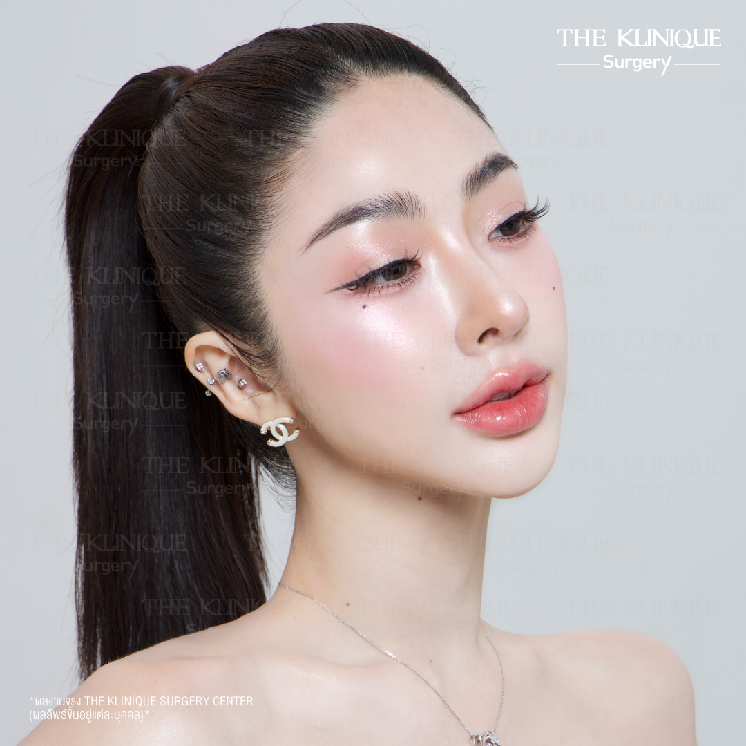 ศัลยกรรมจมูก, ศัลยกรรมจมูก รีวิว, เสริมจมูก, รีวิวเสริมจมูก, ทำจมูก, ทำจมูก รีวิว, ทำจมูกแบบ Open, ซิลิโคนจมูก, จมูก Open, เสริมจมูกโอเพ่น, เสริมจมูกOpen ที่ไหนดี, เสริมจมูกโอเพ่น ที่ไหนดี, เสริมจมูกโอเพ่น Open คือ, รีวิวเสริมจมูกโอเพ่น Open, ทรงจมูก, ทรงจมูกสวย, ทรงจมูกธรรมชาติ, ทรงจมูกสโลปปลายพุ่ง,ทรงจมูก,จมูก พส, จีน พส จีน