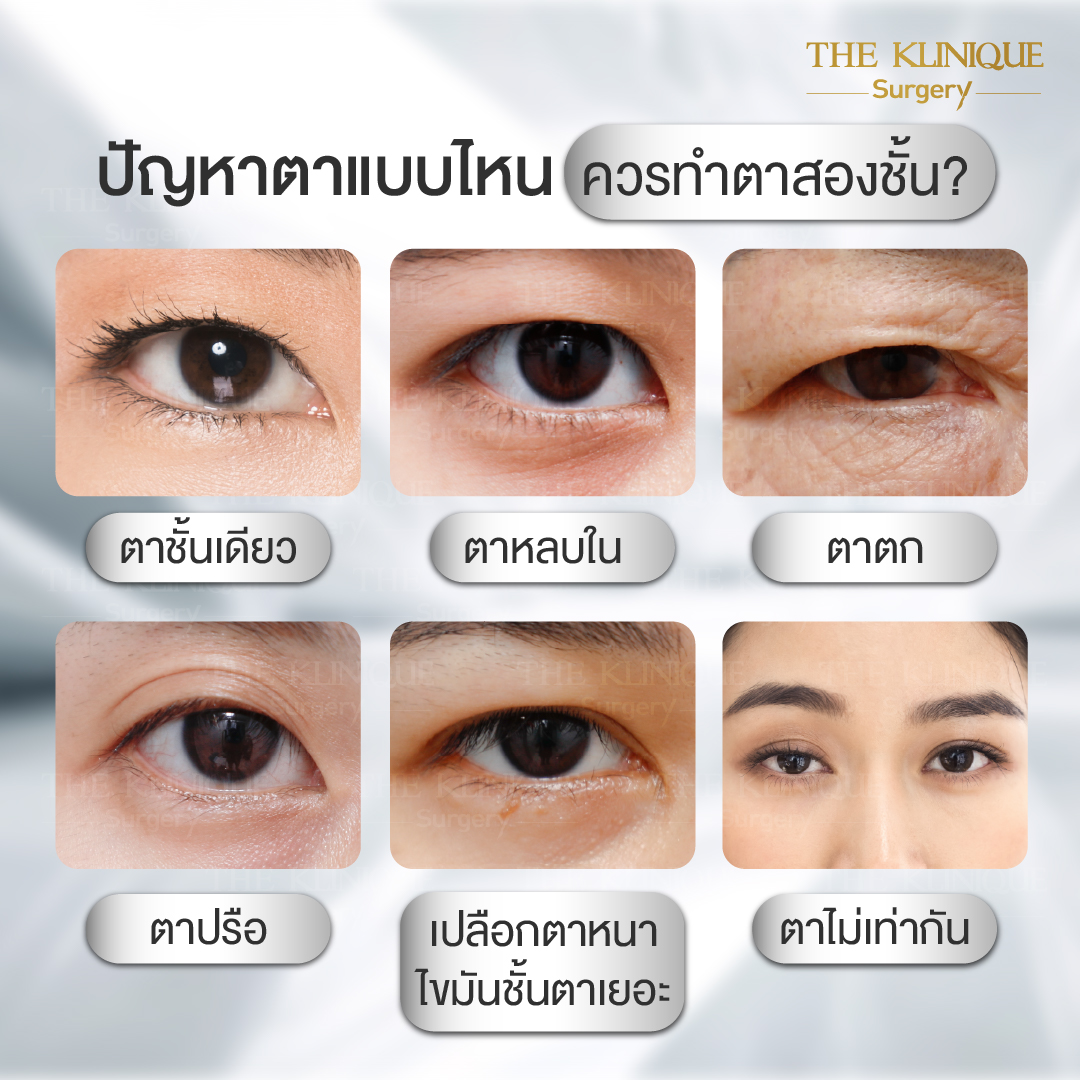 ศัลยกรรมตา, ศัลยกรรมตาสองชั้น, ศัลยกรรมตาสองชั้น ราคา, ศัลยกรรมตาที่ไหนดี, ศัลยกรรมตามีกี่แบบ, ตาสองชั้น, ตาสองชั้นหลบใน, คลินิกทำตา, ตาสองชั้นที่ไหนดี, ตาสองชั้นแบบกรีดสั้น กรีดยาว, กล้ามเนื้อตาอ่อนแรง, แก้ตา, แก้ตาสองชั้น, แก้หนังตาตก, แก้ชั้นตาใหญ่, แก้ตาไม่เท่ากัน, หนังตาตก, แก้หนังตาตก, ตาสองชั้นรีวิว, ตา 2 ชั้น, รีวิว ตาสองชั้น, ทำตาสองชั้น, Sub Brow Lift, Foxy eyes, ยกหางตา, หางตาตก, หมอศัลยกรรมตา