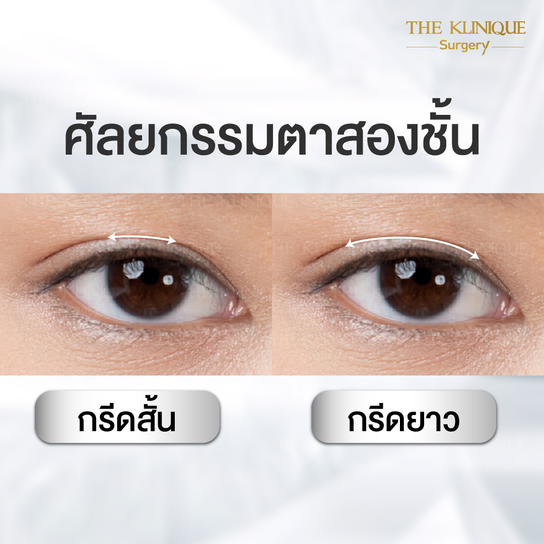 ศัลยกรรมตา, ศัลยกรรมตาสองชั้น, ศัลยกรรมตาสองชั้น ราคา, ศัลยกรรมตาที่ไหนดี, ศัลยกรรมตามีกี่แบบ, ตาสองชั้น, ตาสองชั้นหลบใน, คลินิกทำตา, ตาสองชั้นที่ไหนดี, ตาสองชั้นแบบกรีดสั้น กรีดยาว, กล้ามเนื้อตาอ่อนแรง, แก้ตา, แก้ตาสองชั้น, แก้หนังตาตก, แก้ชั้นตาใหญ่, แก้ตาไม่เท่ากัน, หนังตาตก, แก้หนังตาตก, ตาสองชั้นรีวิว, ตา 2 ชั้น, รีวิว ตาสองชั้น, ทำตาสองชั้น, Sub Brow Lift, Foxy eyes, ยกหางตา, หางตาตก, หมอศัลยกรรมตา