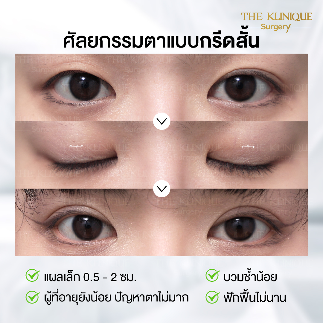 ศัลยกรรมตา, ศัลยกรรมตาสองชั้น, ศัลยกรรมตาสองชั้น ราคา, ศัลยกรรมตาที่ไหนดี, ศัลยกรรมตามีกี่แบบ, ตาสองชั้น, ตาสองชั้นหลบใน, คลินิกทำตา, ตาสองชั้นที่ไหนดี, ตาสองชั้นแบบกรีดสั้น กรีดยาว, กล้ามเนื้อตาอ่อนแรง, แก้ตา, แก้ตาสองชั้น, แก้หนังตาตก, แก้ชั้นตาใหญ่, แก้ตาไม่เท่ากัน, หนังตาตก, แก้หนังตาตก, ตาสองชั้นรีวิว, ตา 2 ชั้น, รีวิว ตาสองชั้น, ทำตาสองชั้น, Sub Brow Lift, Foxy eyes, ยกหางตา, หางตาตก, หมอศัลยกรรมตา