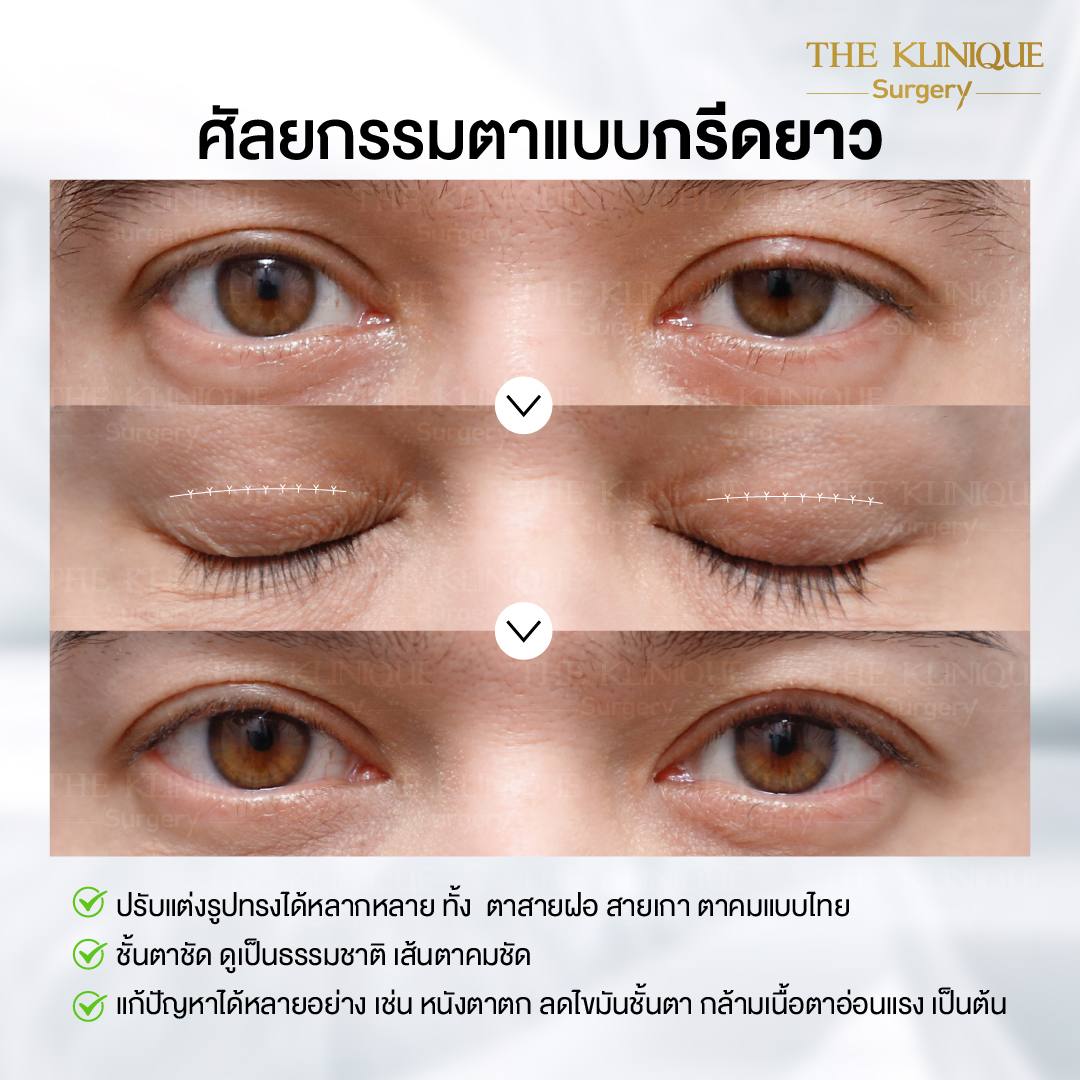 ศัลยกรรมตา, ศัลยกรรมตาสองชั้น, ศัลยกรรมตาสองชั้น ราคา, ศัลยกรรมตาที่ไหนดี, ศัลยกรรมตามีกี่แบบ, ตาสองชั้น, ตาสองชั้นหลบใน, คลินิกทำตา, ตาสองชั้นที่ไหนดี, ตาสองชั้นแบบกรีดสั้น กรีดยาว, กล้ามเนื้อตาอ่อนแรง, แก้ตา, แก้ตาสองชั้น, แก้หนังตาตก, แก้ชั้นตาใหญ่, แก้ตาไม่เท่ากัน, หนังตาตก, แก้หนังตาตก, ตาสองชั้นรีวิว, ตา 2 ชั้น, รีวิว ตาสองชั้น, ทำตาสองชั้น, Sub Brow Lift, Foxy eyes, ยกหางตา, หางตาตก, หมอศัลยกรรมตา