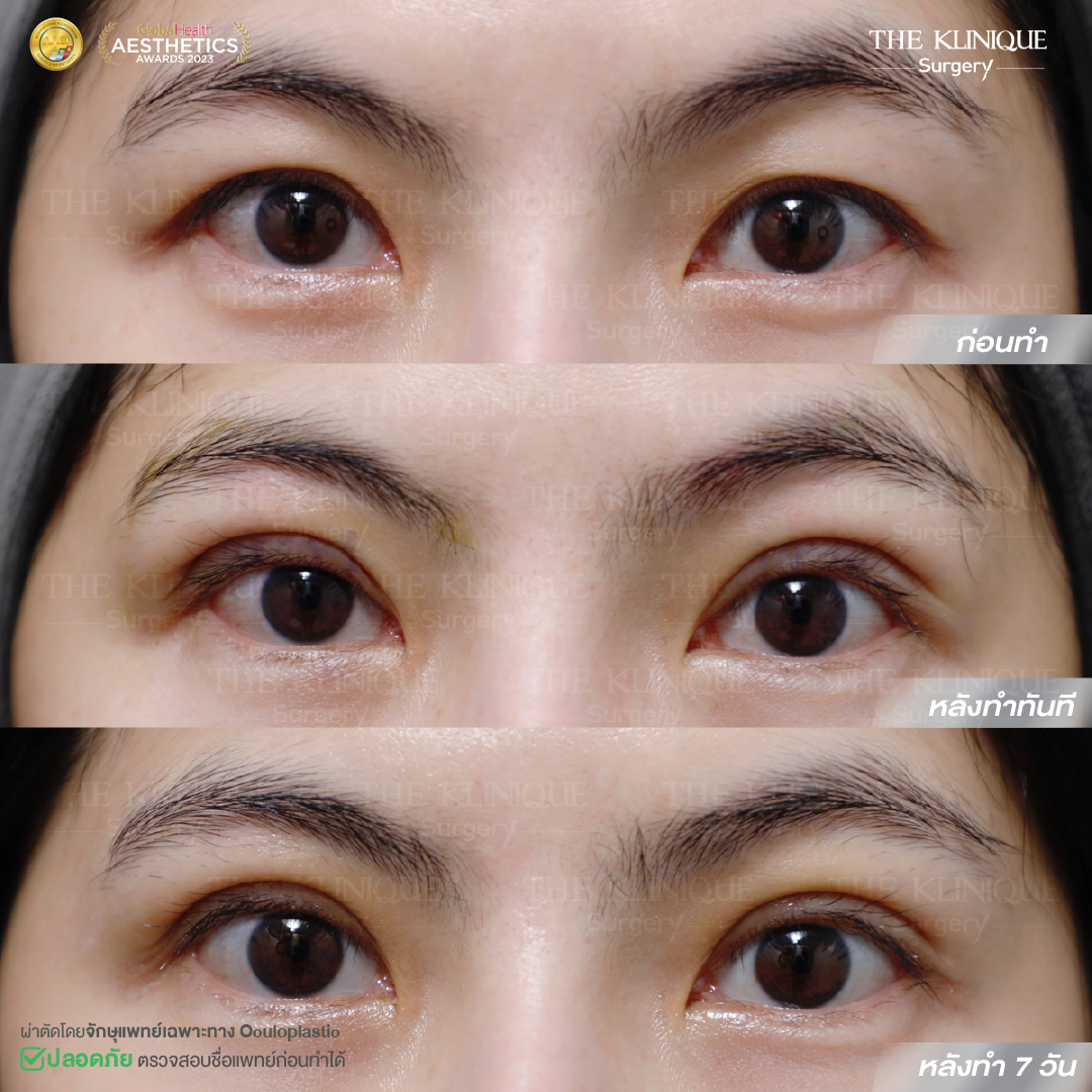 ศัลยกรรมตา, ศัลยกรรมตาสองชั้น, ศัลยกรรมตาสองชั้น ราคา, ศัลยกรรมตาที่ไหนดี, ศัลยกรรมตามีกี่แบบ, ตาสองชั้น, ตาสองชั้นหลบใน, คลินิกทำตา, ตาสองชั้นที่ไหนดี, ตาสองชั้นแบบกรีดสั้น กรีดยาว, กล้ามเนื้อตาอ่อนแรง, แก้ตา, แก้ตาสองชั้น, แก้หนังตาตก, แก้ชั้นตาใหญ่, แก้ตาไม่เท่ากัน, หนังตาตก, แก้หนังตาตก, ตาสองชั้นรีวิว, ตา 2 ชั้น, รีวิว ตาสองชั้น, ทำตาสองชั้น, Sub Brow Lift, Foxy eyes, ยกหางตา, หางตาตก, หมอศัลยกรรมตา