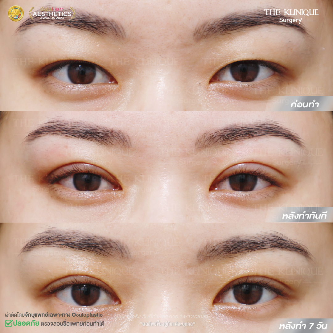 ศัลยกรรมตา, ศัลยกรรมตาสองชั้น, ศัลยกรรมตาสองชั้น ราคา, ศัลยกรรมตาที่ไหนดี, ศัลยกรรมตามีกี่แบบ, ตาสองชั้น, ตาสองชั้นหลบใน, คลินิกทำตา, ตาสองชั้นที่ไหนดี, ตาสองชั้นแบบกรีดสั้น กรีดยาว, กล้ามเนื้อตาอ่อนแรง, แก้ตา, แก้ตาสองชั้น, แก้หนังตาตก, แก้ชั้นตาใหญ่, แก้ตาไม่เท่ากัน, หนังตาตก, แก้หนังตาตก, ตาสองชั้นรีวิว, ตา 2 ชั้น, รีวิว ตาสองชั้น, ทำตาสองชั้น, Sub Brow Lift, Foxy eyes, ยกหางตา, หางตาตก, หมอศัลยกรรมตา