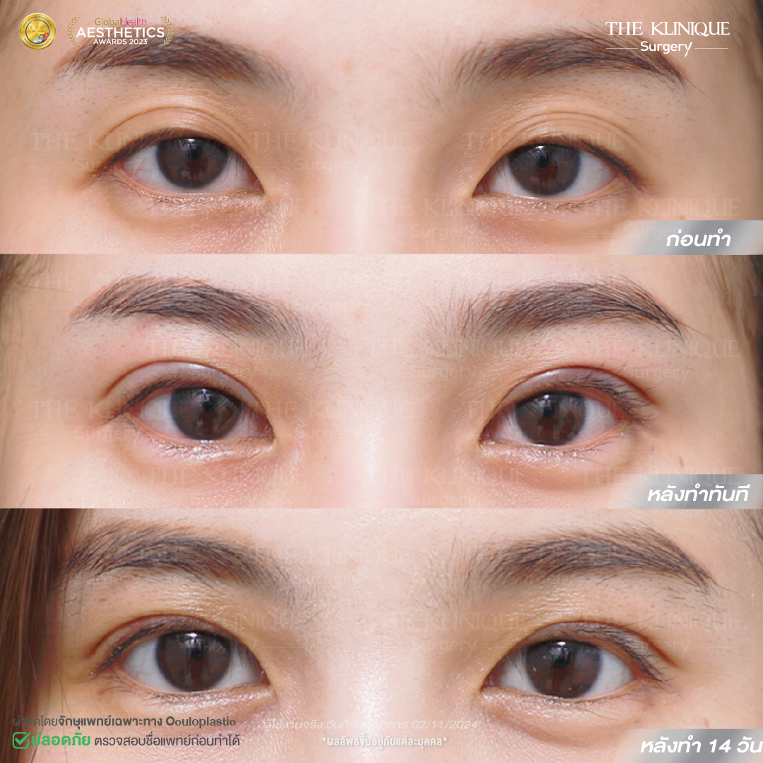 ศัลยกรรมตา, ศัลยกรรมตาสองชั้น, ศัลยกรรมตาสองชั้น ราคา, ศัลยกรรมตาที่ไหนดี, ศัลยกรรมตามีกี่แบบ, ตาสองชั้น, ตาสองชั้นหลบใน, คลินิกทำตา, ตาสองชั้นที่ไหนดี, ตาสองชั้นแบบกรีดสั้น กรีดยาว, กล้ามเนื้อตาอ่อนแรง, แก้ตา, แก้ตาสองชั้น, แก้หนังตาตก, แก้ชั้นตาใหญ่, แก้ตาไม่เท่ากัน, หนังตาตก, แก้หนังตาตก, ตาสองชั้นรีวิว, ตา 2 ชั้น, รีวิว ตาสองชั้น, ทำตาสองชั้น, Sub Brow Lift, Foxy eyes, ยกหางตา, หางตาตก, หมอศัลยกรรมตา