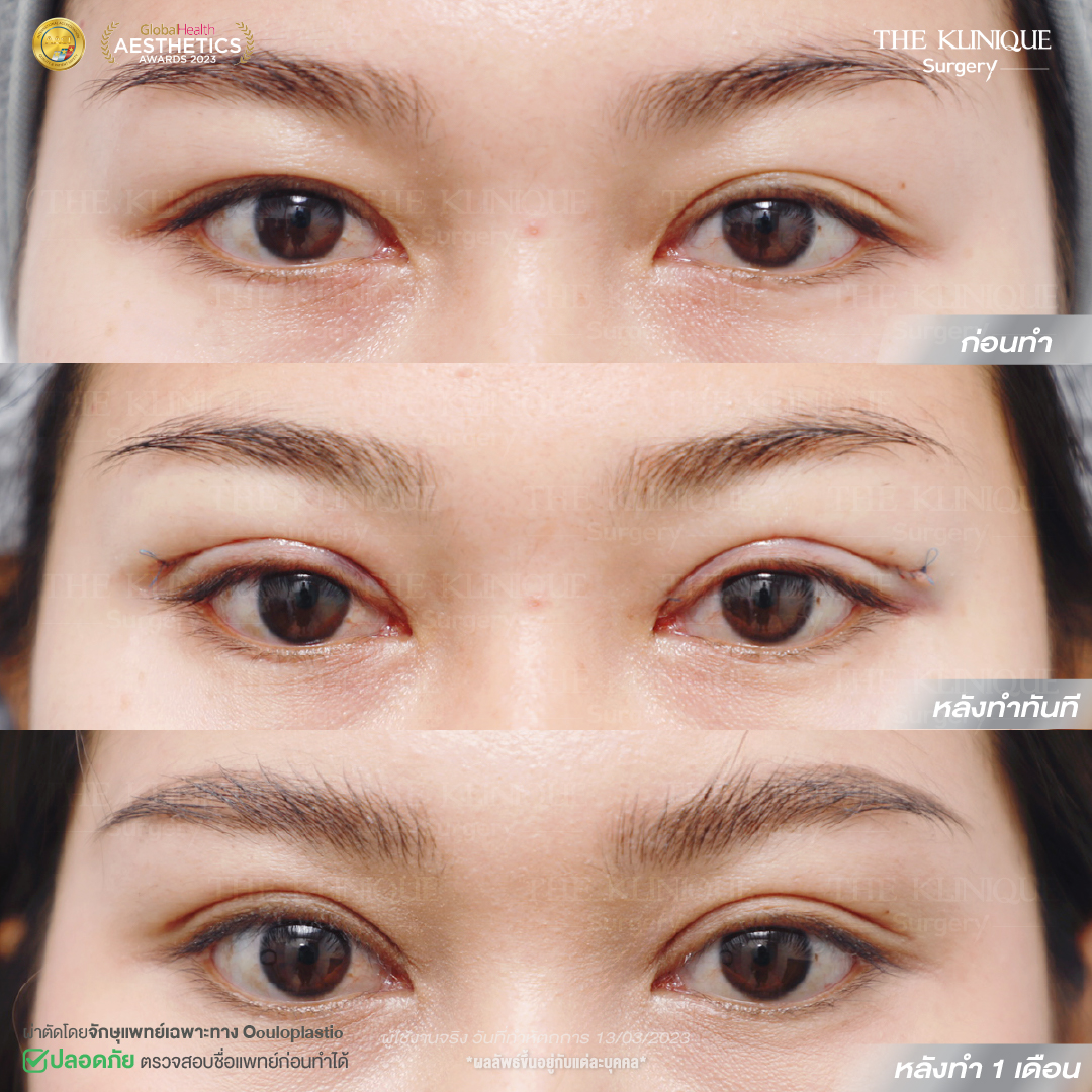 ศัลยกรรมตา, ศัลยกรรมตาสองชั้น, ศัลยกรรมตาสองชั้น ราคา, ศัลยกรรมตาที่ไหนดี, ศัลยกรรมตามีกี่แบบ, ตาสองชั้น, ตาสองชั้นหลบใน, คลินิกทำตา, ตาสองชั้นที่ไหนดี, ตาสองชั้นแบบกรีดสั้น กรีดยาว, กล้ามเนื้อตาอ่อนแรง, แก้ตา, แก้ตาสองชั้น, แก้หนังตาตก, แก้ชั้นตาใหญ่, แก้ตาไม่เท่ากัน, หนังตาตก, แก้หนังตาตก, ตาสองชั้นรีวิว, ตา 2 ชั้น, รีวิว ตาสองชั้น, ทำตาสองชั้น, Sub Brow Lift, Foxy eyes, ยกหางตา, หางตาตก, หมอศัลยกรรมตา