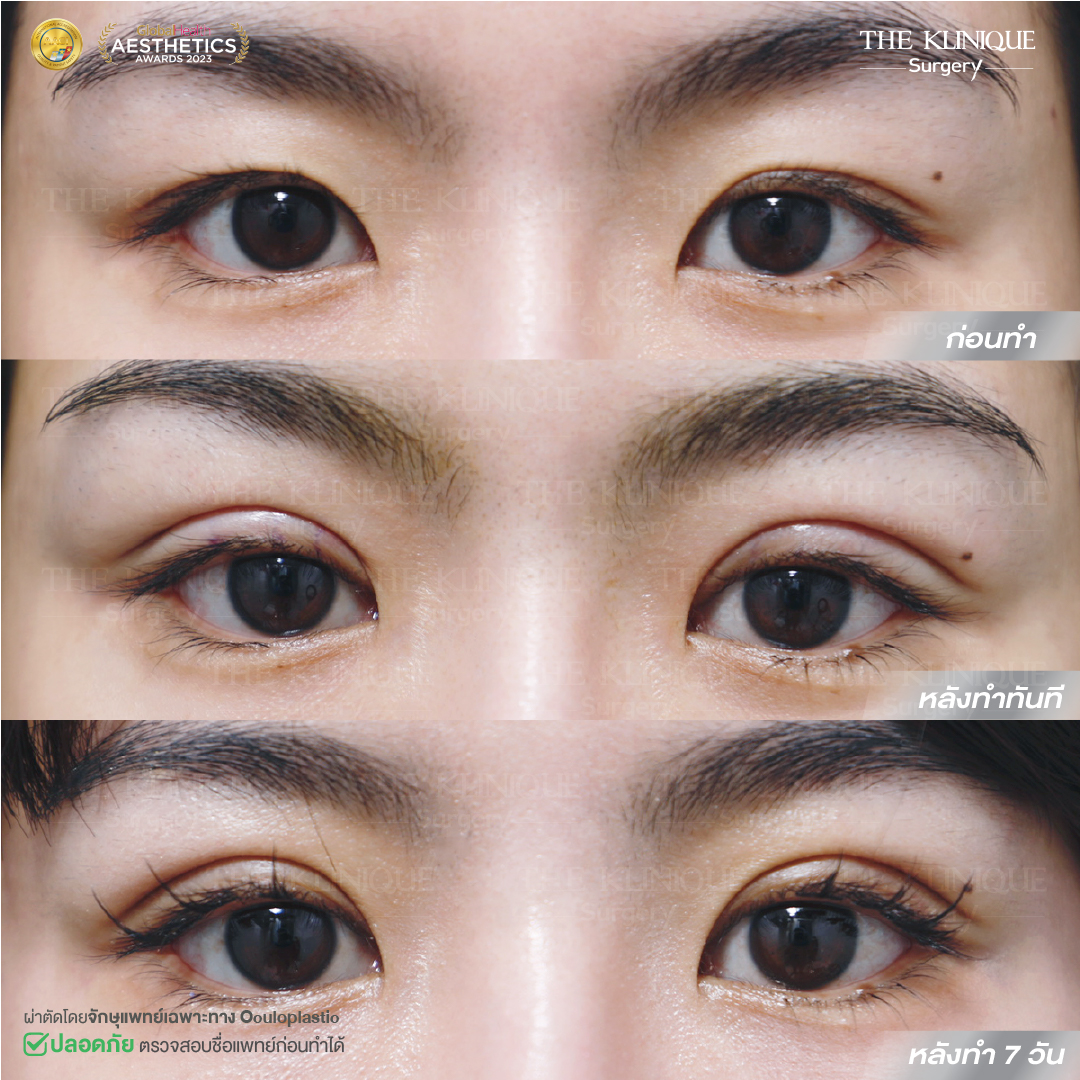 ศัลยกรรมตา, ศัลยกรรมตาสองชั้น, ศัลยกรรมตาสองชั้น ราคา, ศัลยกรรมตาที่ไหนดี, ศัลยกรรมตามีกี่แบบ, ตาสองชั้น, ตาสองชั้นหลบใน, คลินิกทำตา, ตาสองชั้นที่ไหนดี, ตาสองชั้นแบบกรีดสั้น กรีดยาว, กล้ามเนื้อตาอ่อนแรง, แก้ตา, แก้ตาสองชั้น, แก้หนังตาตก, แก้ชั้นตาใหญ่, แก้ตาไม่เท่ากัน, หนังตาตก, แก้หนังตาตก, ตาสองชั้นรีวิว, ตา 2 ชั้น, รีวิว ตาสองชั้น, ทำตาสองชั้น, Sub Brow Lift, Foxy eyes, ยกหางตา, หางตาตก, หมอศัลยกรรมตา