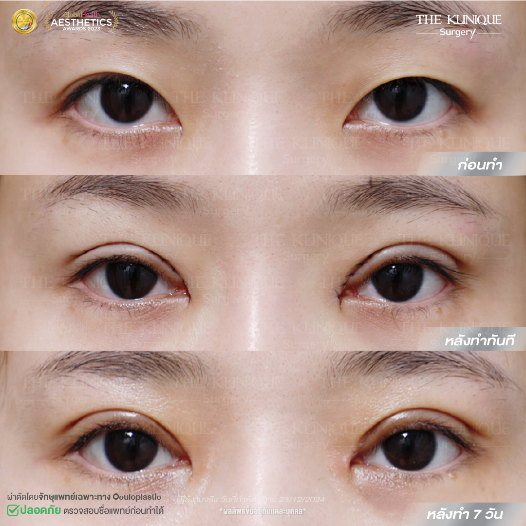 ศัลยกรรมตา, ศัลยกรรมตาสองชั้น, ศัลยกรรมตาสองชั้น ราคา, ศัลยกรรมตาที่ไหนดี, ศัลยกรรมตามีกี่แบบ, ตาสองชั้น, ตาสองชั้นหลบใน, คลินิกทำตา, ตาสองชั้นที่ไหนดี, ตาสองชั้นแบบกรีดสั้น กรีดยาว, กล้ามเนื้อตาอ่อนแรง, แก้ตา, แก้ตาสองชั้น, แก้หนังตาตก, แก้ชั้นตาใหญ่, แก้ตาไม่เท่ากัน, หนังตาตก, แก้หนังตาตก, ตาสองชั้นรีวิว, ตา 2 ชั้น, รีวิว ตาสองชั้น, ทำตาสองชั้น, Sub Brow Lift, Foxy eyes, ยกหางตา, หางตาตก, หมอศัลยกรรมตา