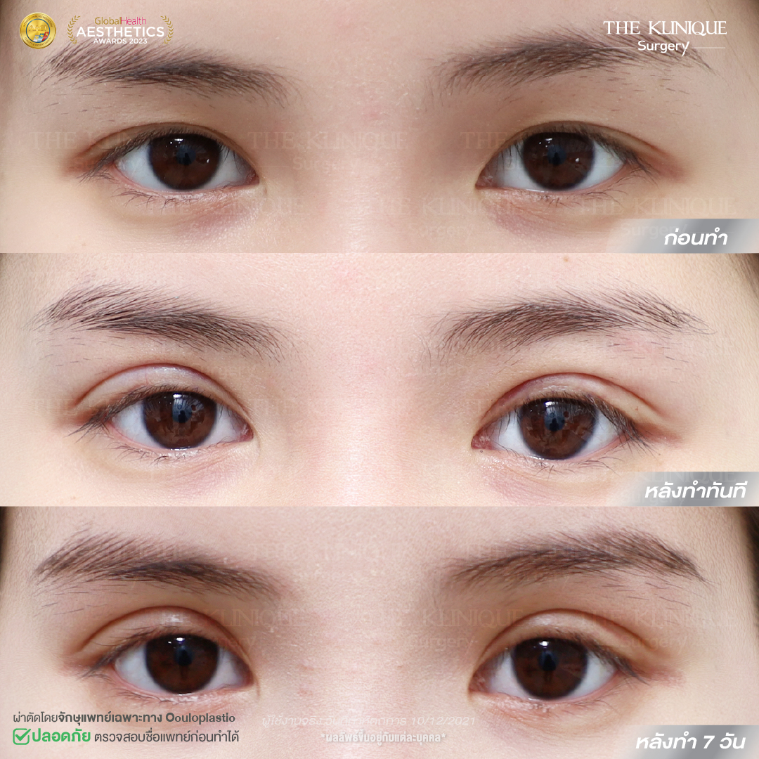 ศัลยกรรมตา, ศัลยกรรมตาสองชั้น, ศัลยกรรมตาสองชั้น ราคา, ศัลยกรรมตาที่ไหนดี, ศัลยกรรมตามีกี่แบบ, ตาสองชั้น, ตาสองชั้นหลบใน, คลินิกทำตา, ตาสองชั้นที่ไหนดี, ตาสองชั้นแบบกรีดสั้น กรีดยาว, กล้ามเนื้อตาอ่อนแรง, แก้ตา, แก้ตาสองชั้น, แก้หนังตาตก, แก้ชั้นตาใหญ่, แก้ตาไม่เท่ากัน, หนังตาตก, แก้หนังตาตก, ตาสองชั้นรีวิว, ตา 2 ชั้น, รีวิว ตาสองชั้น, ทำตาสองชั้น, Sub Brow Lift, Foxy eyes, ยกหางตา, หางตาตก, หมอศัลยกรรมตา