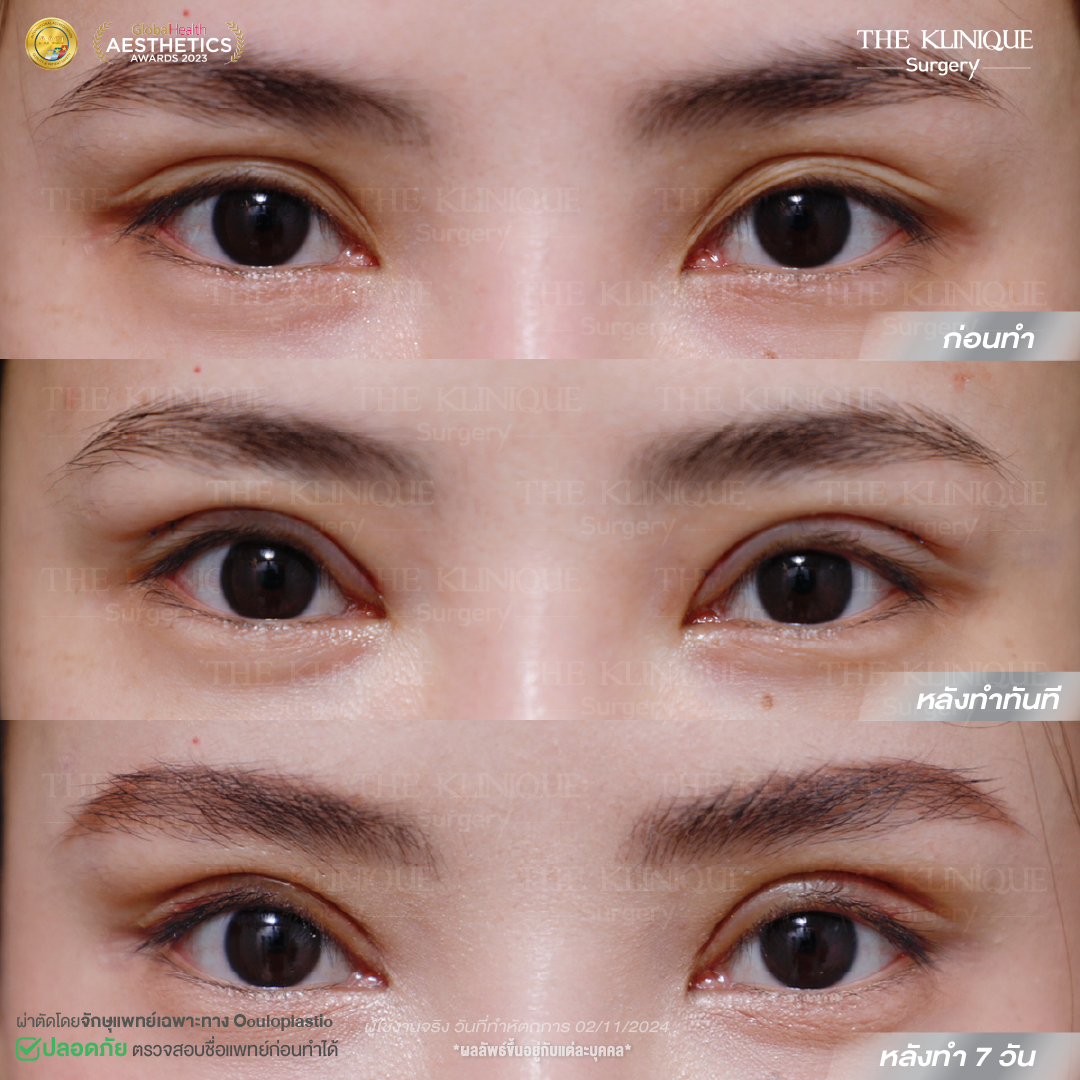 ศัลยกรรมตา, ศัลยกรรมตาสองชั้น, ศัลยกรรมตาสองชั้น ราคา, ศัลยกรรมตาที่ไหนดี, ศัลยกรรมตามีกี่แบบ, ตาสองชั้น, ตาสองชั้นหลบใน, คลินิกทำตา, ตาสองชั้นที่ไหนดี, ตาสองชั้นแบบกรีดสั้น กรีดยาว, กล้ามเนื้อตาอ่อนแรง, แก้ตา, แก้ตาสองชั้น, แก้หนังตาตก, แก้ชั้นตาใหญ่, แก้ตาไม่เท่ากัน, หนังตาตก, แก้หนังตาตก, ตาสองชั้นรีวิว, ตา 2 ชั้น, รีวิว ตาสองชั้น, ทำตาสองชั้น, Sub Brow Lift, Foxy eyes, ยกหางตา, หางตาตก, หมอศัลยกรรมตา