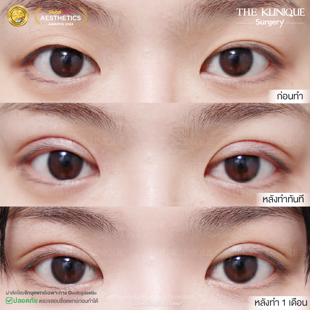 ศัลยกรรมตา, ศัลยกรรมตาสองชั้น, ศัลยกรรมตาสองชั้น ราคา, ศัลยกรรมตาที่ไหนดี, ศัลยกรรมตามีกี่แบบ, ตาสองชั้น, ตาสองชั้นหลบใน, คลินิกทำตา, ตาสองชั้นที่ไหนดี, ตาสองชั้นแบบกรีดสั้น กรีดยาว, กล้ามเนื้อตาอ่อนแรง, แก้ตา, แก้ตาสองชั้น, แก้หนังตาตก, แก้ชั้นตาใหญ่, แก้ตาไม่เท่ากัน, หนังตาตก, แก้หนังตาตก, ตาสองชั้นรีวิว, ตา 2 ชั้น, รีวิว ตาสองชั้น, ทำตาสองชั้น, Sub Brow Lift, Foxy eyes, ยกหางตา, หางตาตก, หมอศัลยกรรมตา