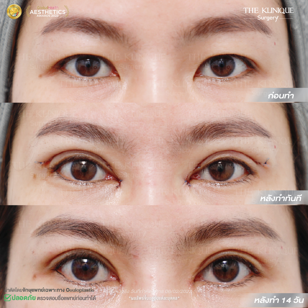 ศัลยกรรมตา, ศัลยกรรมตาสองชั้น, ศัลยกรรมตาสองชั้น ราคา, ศัลยกรรมตาที่ไหนดี, ศัลยกรรมตามีกี่แบบ, ตาสองชั้น, ตาสองชั้นหลบใน, คลินิกทำตา, ตาสองชั้นที่ไหนดี, ตาสองชั้นแบบกรีดสั้น กรีดยาว, กล้ามเนื้อตาอ่อนแรง, แก้ตา, แก้ตาสองชั้น, แก้หนังตาตก, แก้ชั้นตาใหญ่, แก้ตาไม่เท่ากัน, หนังตาตก, แก้หนังตาตก, ตาสองชั้นรีวิว, ตา 2 ชั้น, รีวิว ตาสองชั้น, ทำตาสองชั้น, Sub Brow Lift, Foxy eyes, ยกหางตา, หางตาตก, หมอศัลยกรรมตา