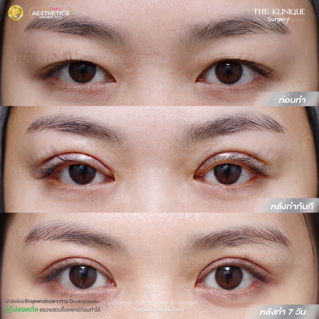 ศัลยกรรมตา, ศัลยกรรมตาสองชั้น, ศัลยกรรมตาสองชั้น ราคา, ศัลยกรรมตาที่ไหนดี, ศัลยกรรมตามีกี่แบบ, ตาสองชั้น, ตาสองชั้นหลบใน, คลินิกทำตา, ตาสองชั้นที่ไหนดี, ตาสองชั้นแบบกรีดสั้น กรีดยาว, กล้ามเนื้อตาอ่อนแรง, แก้ตา, แก้ตาสองชั้น, แก้หนังตาตก, แก้ชั้นตาใหญ่, แก้ตาไม่เท่ากัน, หนังตาตก, แก้หนังตาตก, ตาสองชั้นรีวิว, ตา 2 ชั้น, รีวิว ตาสองชั้น, ทำตาสองชั้น, Sub Brow Lift, Foxy eyes, ยกหางตา, หางตาตก, หมอศัลยกรรมตา