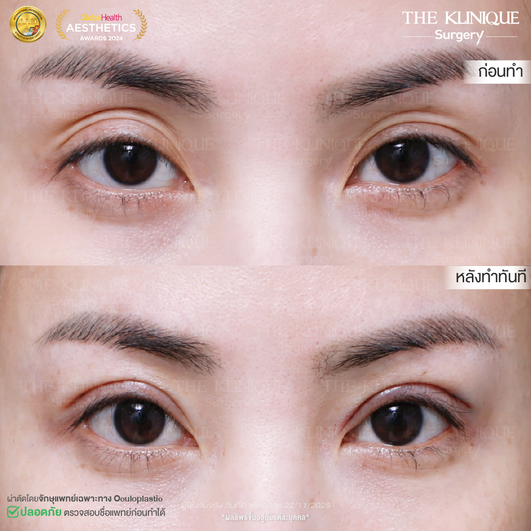 ศัลยกรรมตา, ศัลยกรรมตาสองชั้น, ศัลยกรรมตาสองชั้น ราคา, ศัลยกรรมตาที่ไหนดี, ศัลยกรรมตามีกี่แบบ, ตาสองชั้น, ตาสองชั้นหลบใน, คลินิกทำตา, ตาสองชั้นที่ไหนดี, ตาสองชั้นแบบกรีดสั้น กรีดยาว, กล้ามเนื้อตาอ่อนแรง, แก้ตา, แก้ตาสองชั้น, แก้หนังตาตก, แก้ชั้นตาใหญ่, แก้ตาไม่เท่ากัน, หนังตาตก, แก้หนังตาตก, ตาสองชั้นรีวิว, ตา 2 ชั้น, รีวิว ตาสองชั้น, ทำตาสองชั้น, Sub Brow Lift, Foxy eyes, ยกหางตา, หางตาตก, หมอศัลยกรรมตา