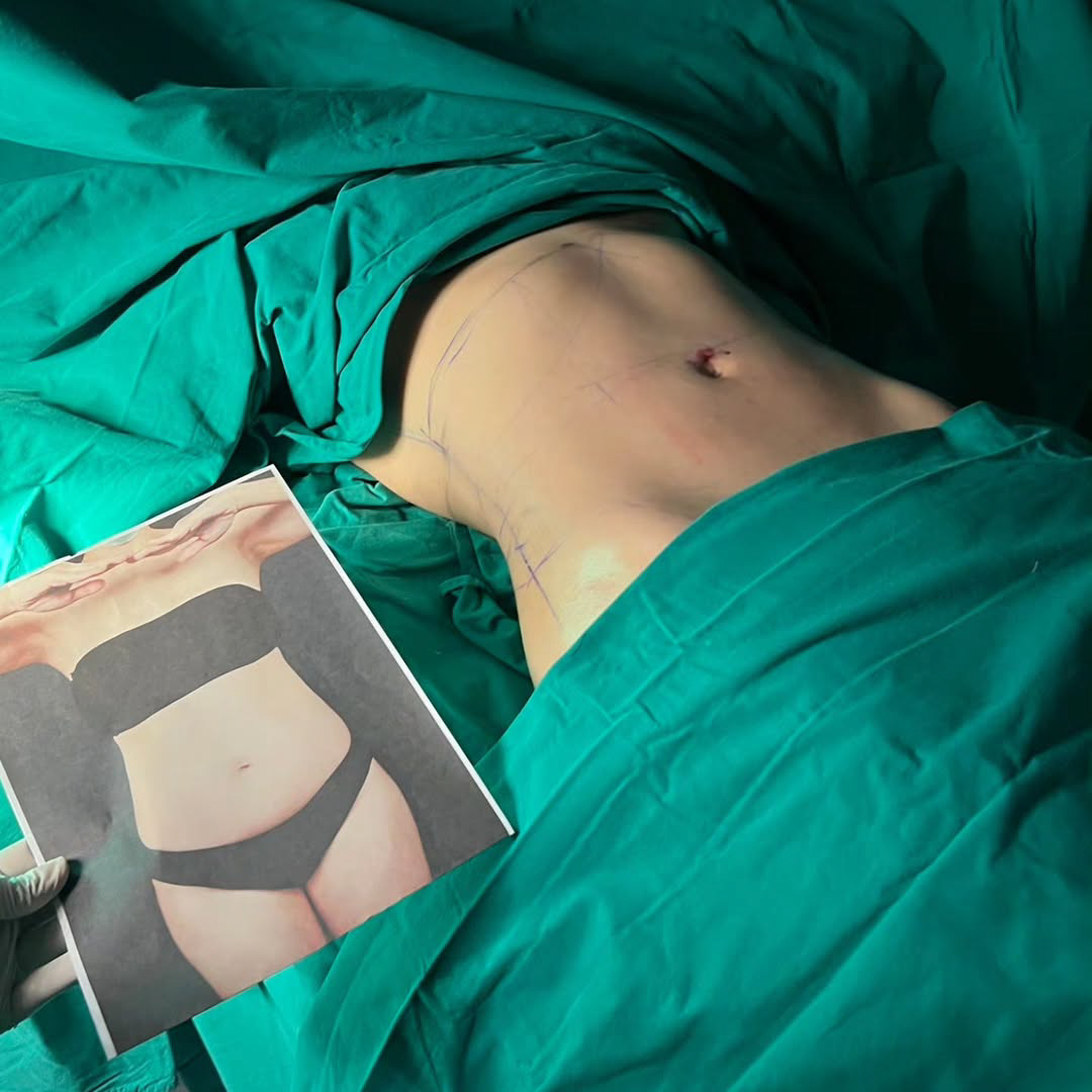 Liposuction, Sculpting,Xshape,Lipo, ศัลยกรรมดูดไขมัน, ดูดไขมัน,คลินิกดูดไขมัน,ดูดไขมันเฉพาะส่วน,ดูดไขมันเหนียง,ดูดไขมันหน้าท้อง,ดูดไขมันรีวิว, รีวิวดูดไขมัน, รีวิวดูดไขมันหน้าท้อง,ดูดไขมันต้นแขน, ดูดไขมันต้นขา,ดูดไขมันน่อง, ลดความอ้วน, ดูดไขมันที่ไหนดี, ดูดไขมันราคา, ดูดไขมันทั้งตัว,รีวิวดูดไขมันต้นขา,เอวเอส, เอวเล็ก, เอวคอด, ปั้นเอว, ปั้นหุ่น,สร้างซิกแพค,ร่อง 11,ปั้นร่อง11, ลดเอวหนา, ปั้นร่อง 11 ผู้หญิง, ลดน้าท้อง, ลดต้นแขนล ลดต้นขา, ดูดไขมัน ลดหุ่น, เอวบาง, Sexyline, Sexyline รีวิว