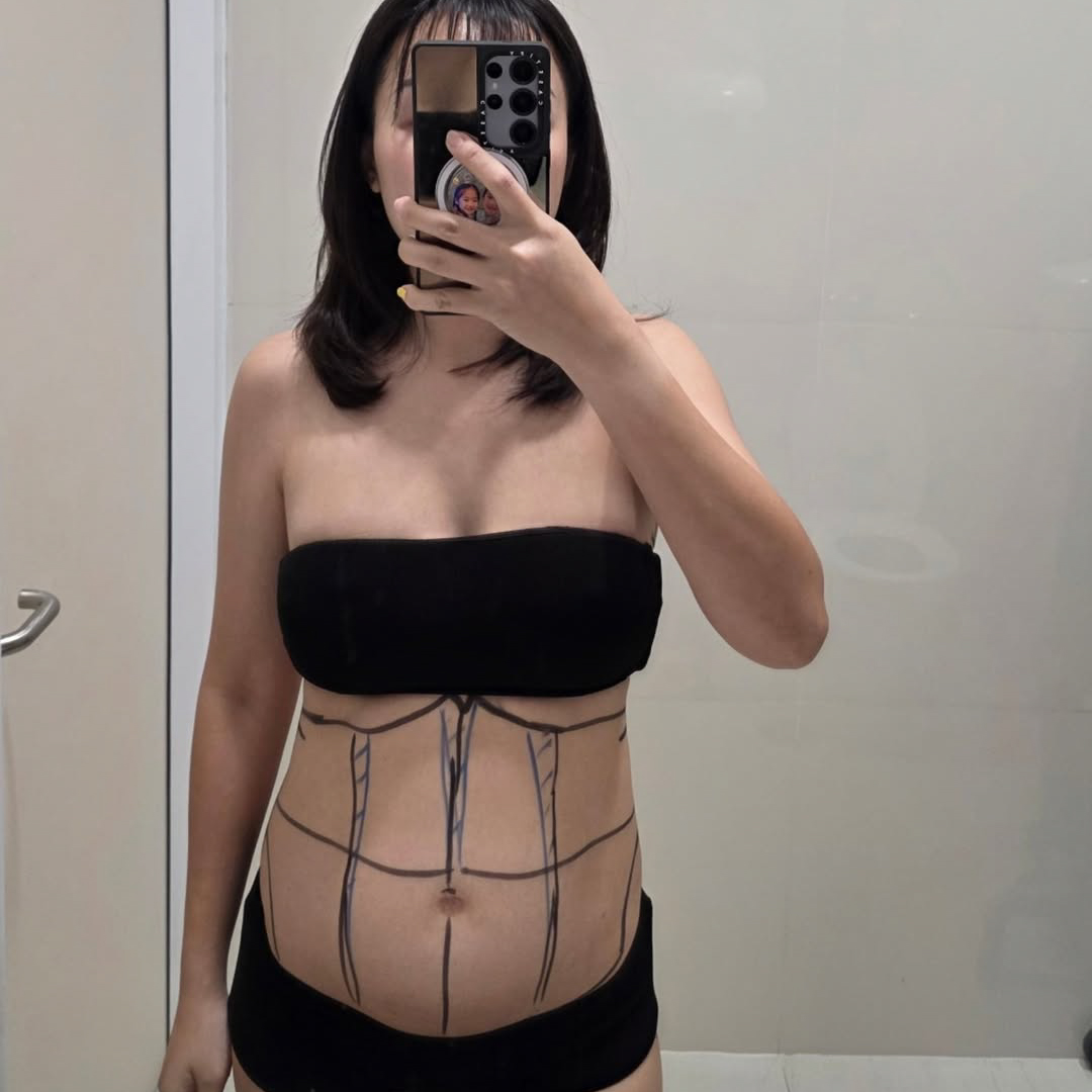 Liposuction, Sculpting,Xshape,Lipo, ศัลยกรรมดูดไขมัน, ดูดไขมัน,คลินิกดูดไขมัน,ดูดไขมันเฉพาะส่วน,ดูดไขมันเหนียง,ดูดไขมันหน้าท้อง,ดูดไขมันรีวิว, รีวิวดูดไขมัน, รีวิวดูดไขมันหน้าท้อง,ดูดไขมันต้นแขน, ดูดไขมันต้นขา,ดูดไขมันน่อง, ลดความอ้วน, ดูดไขมันที่ไหนดี, ดูดไขมันราคา, ดูดไขมันทั้งตัว,รีวิวดูดไขมันต้นขา,เอวเอส, เอวเล็ก, เอวคอด, ปั้นเอว, ปั้นหุ่น,สร้างซิกแพค,ร่อง 11,ปั้นร่อง11, ลดเอวหนา, ปั้นร่อง 11 ผู้หญิง, ลดน้าท้อง, ลดต้นแขนล ลดต้นขา, ดูดไขมัน ลดหุ่น, เอวบาง, Sexyline, Sexyline รีวิว