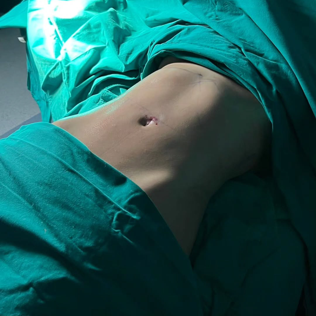 Liposuction, Sculpting,Xshape,Lipo, ศัลยกรรมดูดไขมัน, ดูดไขมัน,คลินิกดูดไขมัน,ดูดไขมันเฉพาะส่วน,ดูดไขมันเหนียง,ดูดไขมันหน้าท้อง,ดูดไขมันรีวิว, รีวิวดูดไขมัน, รีวิวดูดไขมันหน้าท้อง,ดูดไขมันต้นแขน, ดูดไขมันต้นขา,ดูดไขมันน่อง, ลดความอ้วน, ดูดไขมันที่ไหนดี, ดูดไขมันราคา, ดูดไขมันทั้งตัว,รีวิวดูดไขมันต้นขา,เอวเอส, เอวเล็ก, เอวคอด, ปั้นเอว, ปั้นหุ่น,สร้างซิกแพค,ร่อง 11,ปั้นร่อง11, ลดเอวหนา, ปั้นร่อง 11 ผู้หญิง, ลดน้าท้อง, ลดต้นแขนล ลดต้นขา, ดูดไขมัน ลดหุ่น, เอวบาง, Sexyline, Sexyline รีวิว