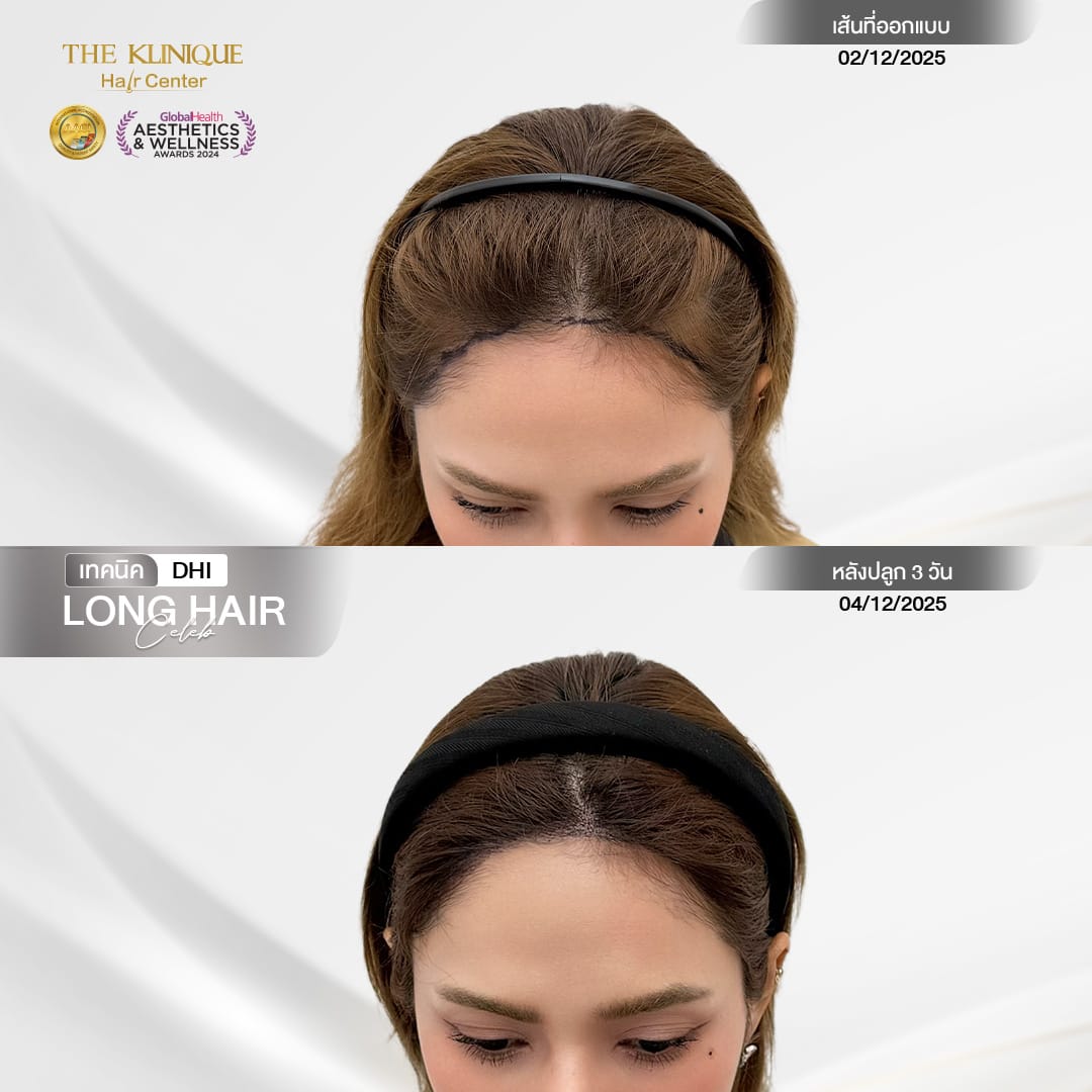 หัตถการศัลยกรรมปลูกผม, ปลูกผมที่ไหนดี, ปลูกผมราคา, ปลูกผมถาวร, ปลูกผม ผมบาง, ปลูกผม ถาวร ราคา,ผมร่วง, ผมร่วงเกิดจากอะไร, ผมร่วง ปลูกผม, ปัญหาผมร่วง, ลดผมร่วง, แก้ผมร่วง, แก้ผมขาดร่วง, คลินกปลูกผม,ปลูกผมบาง, รากผมฝ่อ,ผมบาง, ศัลยกรรมปลูกผม, วิธีแก้ผมบาง, ศูนย์ดูแลเส้นผม, hair center, หัวเถิก, หัวล้าน, ศีรษะล้าน, ปลูกผมเทคนิคไหนดี, ปลูกผมมีกี่แบบ, ปลูกผม FUE, ปลูกผม DHI, รีวิว ปลูกผม , เซลล์กราผม, ยาปลูกผม, กราฟผม, กราฟปลูกผม, กระตุ้นรากผม, กระตุ้นเซลล์ผม, รากผมอ่อนแอ, ปัญหาผม,รักษาเส้นผม, รักษาผมร่วง, รักษารากผม, รักษาผมบาง