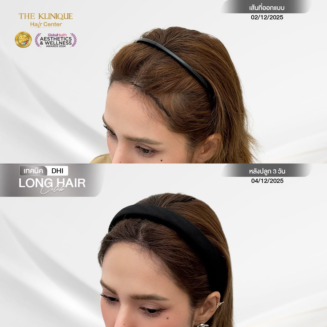 หัตถการศัลยกรรมปลูกผม, ปลูกผมที่ไหนดี, ปลูกผมราคา, ปลูกผมถาวร, ปลูกผม ผมบาง, ปลูกผม ถาวร ราคา,ผมร่วง, ผมร่วงเกิดจากอะไร, ผมร่วง ปลูกผม, ปัญหาผมร่วง, ลดผมร่วง, แก้ผมร่วง, แก้ผมขาดร่วง, คลินกปลูกผม,ปลูกผมบาง, รากผมฝ่อ,ผมบาง, ศัลยกรรมปลูกผม, วิธีแก้ผมบาง, ศูนย์ดูแลเส้นผม, hair center, หัวเถิก, หัวล้าน, ศีรษะล้าน, ปลูกผมเทคนิคไหนดี, ปลูกผมมีกี่แบบ, ปลูกผม FUE, ปลูกผม DHI, รีวิว ปลูกผม , เซลล์กราผม, ยาปลูกผม, กราฟผม, กราฟปลูกผม, กระตุ้นรากผม, กระตุ้นเซลล์ผม, รากผมอ่อนแอ, ปัญหาผม,รักษาเส้นผม, รักษาผมร่วง, รักษารากผม, รักษาผมบาง