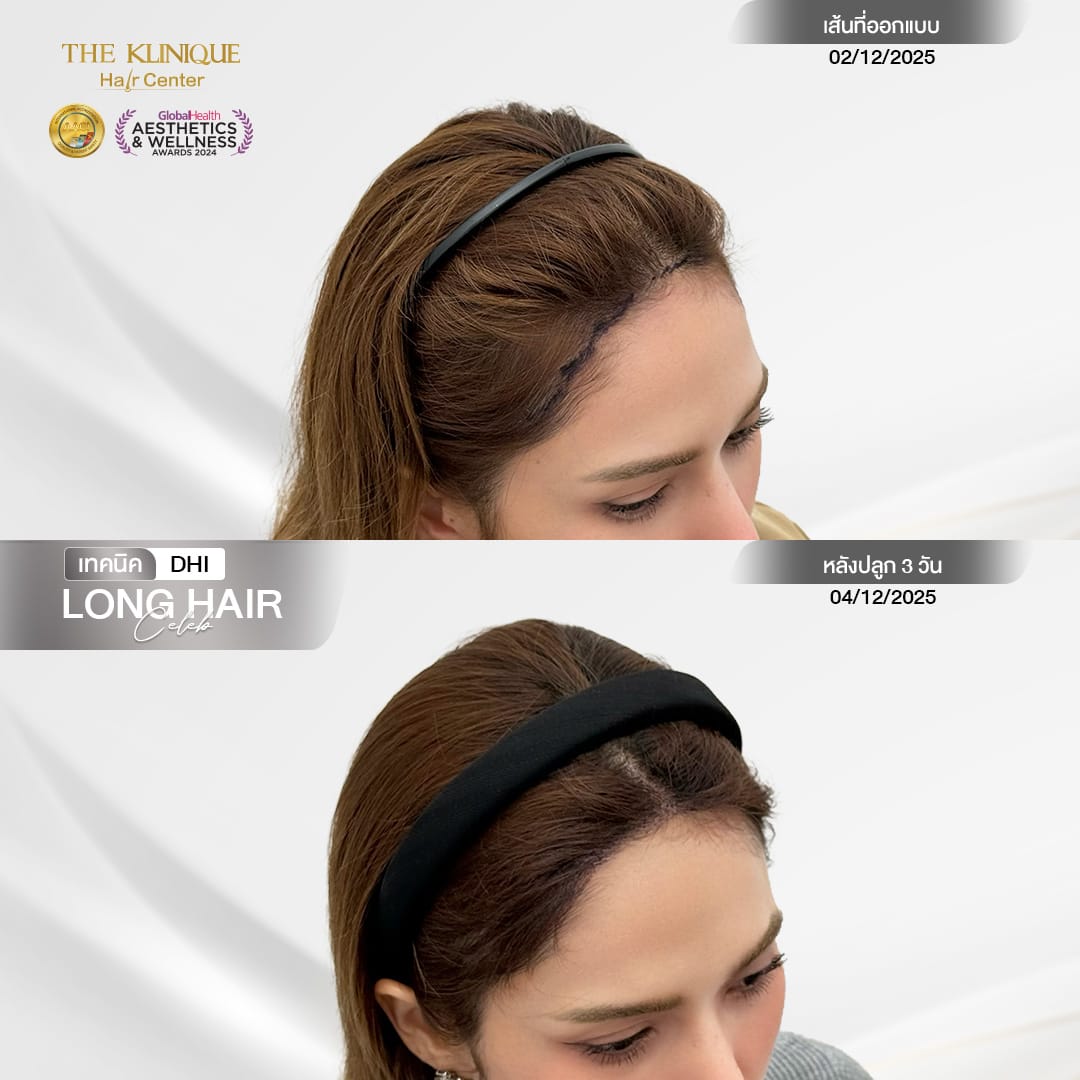 หัตถการศัลยกรรมปลูกผม, ปลูกผมที่ไหนดี, ปลูกผมราคา, ปลูกผมถาวร, ปลูกผม ผมบาง, ปลูกผม ถาวร ราคา,ผมร่วง, ผมร่วงเกิดจากอะไร, ผมร่วง ปลูกผม, ปัญหาผมร่วง, ลดผมร่วง, แก้ผมร่วง, แก้ผมขาดร่วง, คลินกปลูกผม,ปลูกผมบาง, รากผมฝ่อ,ผมบาง, ศัลยกรรมปลูกผม, วิธีแก้ผมบาง, ศูนย์ดูแลเส้นผม, hair center, หัวเถิก, หัวล้าน, ศีรษะล้าน, ปลูกผมเทคนิคไหนดี, ปลูกผมมีกี่แบบ, ปลูกผม FUE, ปลูกผม DHI, รีวิว ปลูกผม , เซลล์กราผม, ยาปลูกผม, กราฟผม, กราฟปลูกผม, กระตุ้นรากผม, กระตุ้นเซลล์ผม, รากผมอ่อนแอ, ปัญหาผม,รักษาเส้นผม, รักษาผมร่วง, รักษารากผม, รักษาผมบาง