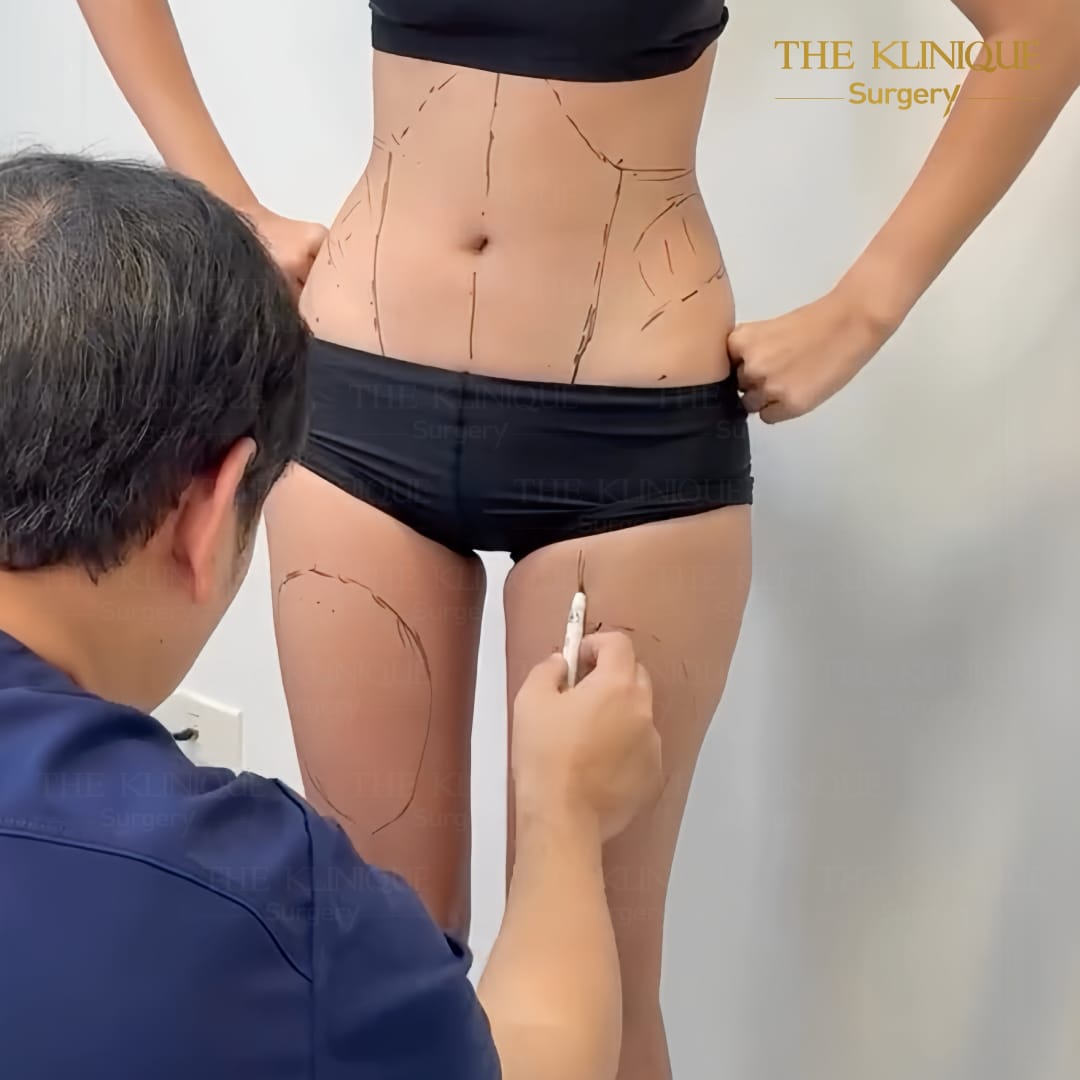 review-maprang-BellyLiposuction