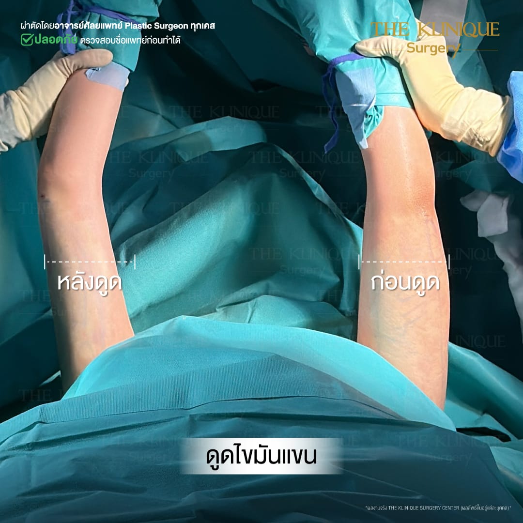 Liposuction, Sculpting,Xshape,Lipo, ศัลยกรรมดูดไขมัน, ดูดไขมัน,คลินิกดูดไขมัน,ดูดไขมันเฉพาะส่วน,ดูดไขมันเหนียง,ดูดไขมันหน้าท้อง,รีวิวดูดไขมัน, รีวิวดูดไขมันหน้าท้อง,ดูดไขมันต้นแขน, ดูดไขมันต้นขา,ลดความอ้วน, ดูดไขมันที่ไหนดี, ดูดไขมันราคา