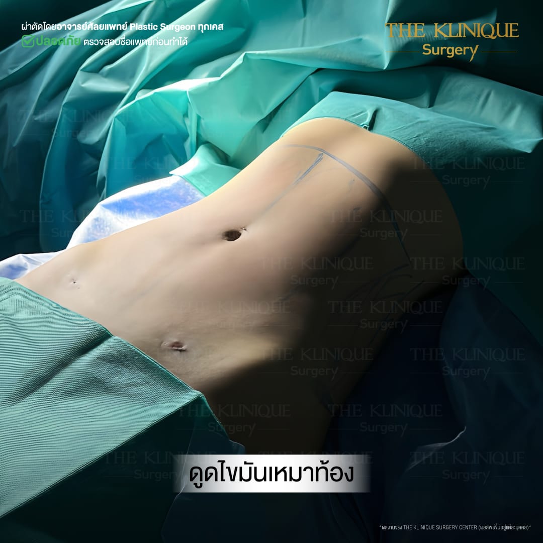 Liposuction, Sculpting,Xshape,Lipo, ศัลยกรรมดูดไขมัน, ดูดไขมัน,คลินิกดูดไขมัน,ดูดไขมันเฉพาะส่วน,ดูดไขมันเหนียง,ดูดไขมันหน้าท้อง,รีวิวดูดไขมัน, รีวิวดูดไขมันหน้าท้อง,ดูดไขมันต้นแขน, ดูดไขมันต้นขา,ลดความอ้วน, ดูดไขมันที่ไหนดี, ดูดไขมันราคา