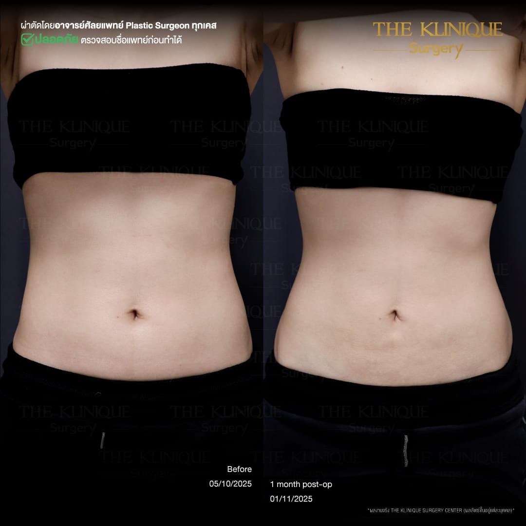 Liposuction, Sculpting,Xshape,Lipo, ศัลยกรรมดูดไขมัน, ดูดไขมัน,คลินิกดูดไขมัน,ดูดไขมันเฉพาะส่วน,ดูดไขมันเหนียง,ดูดไขมันหน้าท้อง,รีวิวดูดไขมัน, รีวิวดูดไขมันหน้าท้อง,ดูดไขมันต้นแขน, ดูดไขมันต้นขา,ลดความอ้วน, ดูดไขมันที่ไหนดี, ดูดไขมันราคา