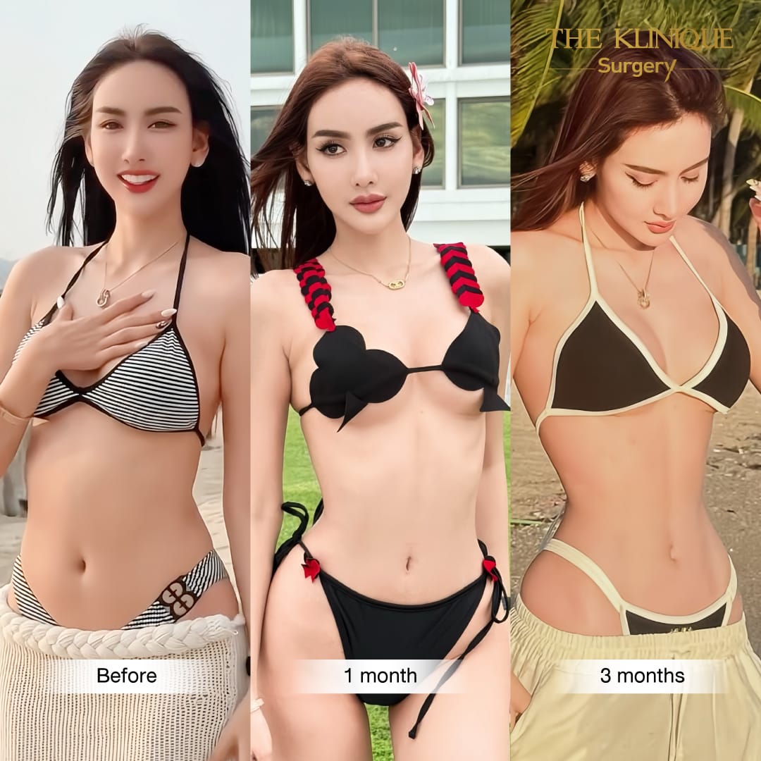 review-maprang-BellyLiposuction