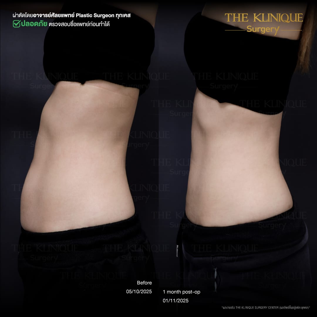 Liposuction, Sculpting,Xshape,Lipo, ศัลยกรรมดูดไขมัน, ดูดไขมัน,คลินิกดูดไขมัน,ดูดไขมันเฉพาะส่วน,ดูดไขมันเหนียง,ดูดไขมันหน้าท้อง,รีวิวดูดไขมัน, รีวิวดูดไขมันหน้าท้อง,ดูดไขมันต้นแขน, ดูดไขมันต้นขา,ลดความอ้วน, ดูดไขมันที่ไหนดี, ดูดไขมันราคา