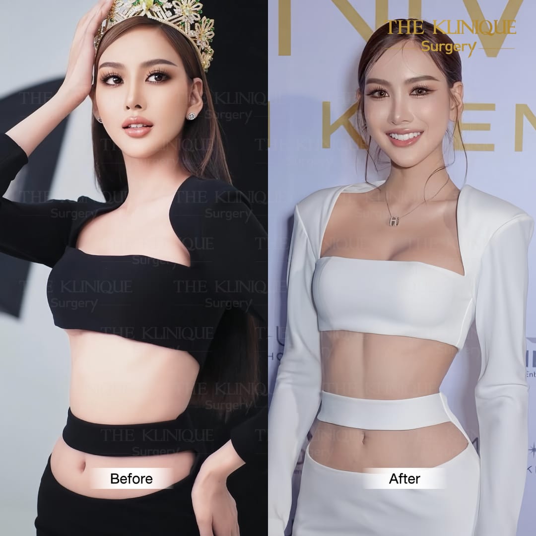 review-maprang-BellyLiposuction