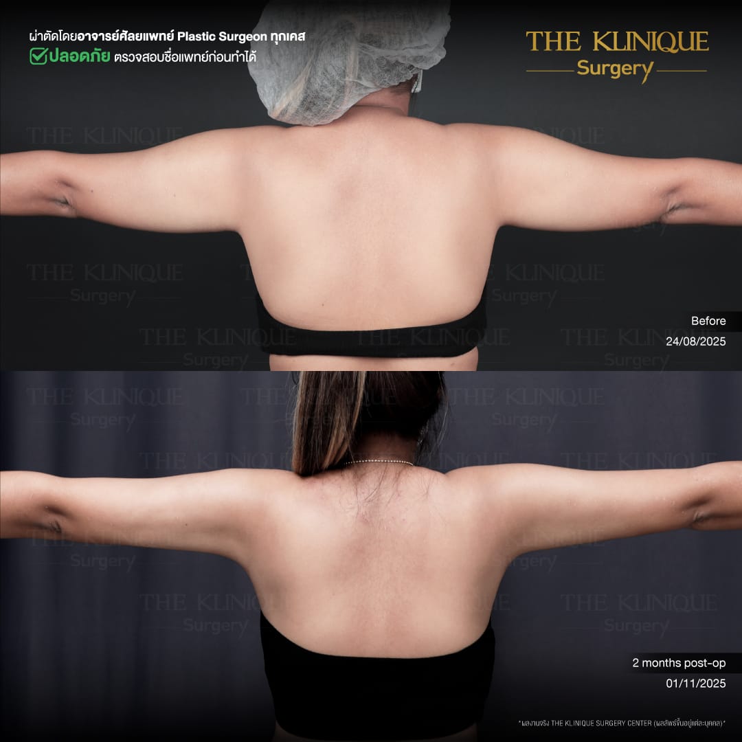 Liposuction, Sculpting,Xshape,Lipo, ศัลยกรรมดูดไขมัน, ดูดไขมัน,คลินิกดูดไขมัน,ดูดไขมันเฉพาะส่วน,ดูดไขมันเหนียง,ดูดไขมันหน้าท้อง,รีวิวดูดไขมัน, รีวิวดูดไขมันหน้าท้อง,ดูดไขมันต้นแขน, ดูดไขมันต้นขา,ลดความอ้วน, ดูดไขมันที่ไหนดี, ดูดไขมันราคา