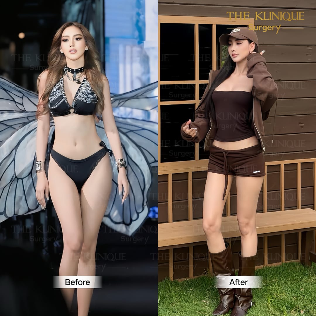 review-maprang-BellyLiposuction