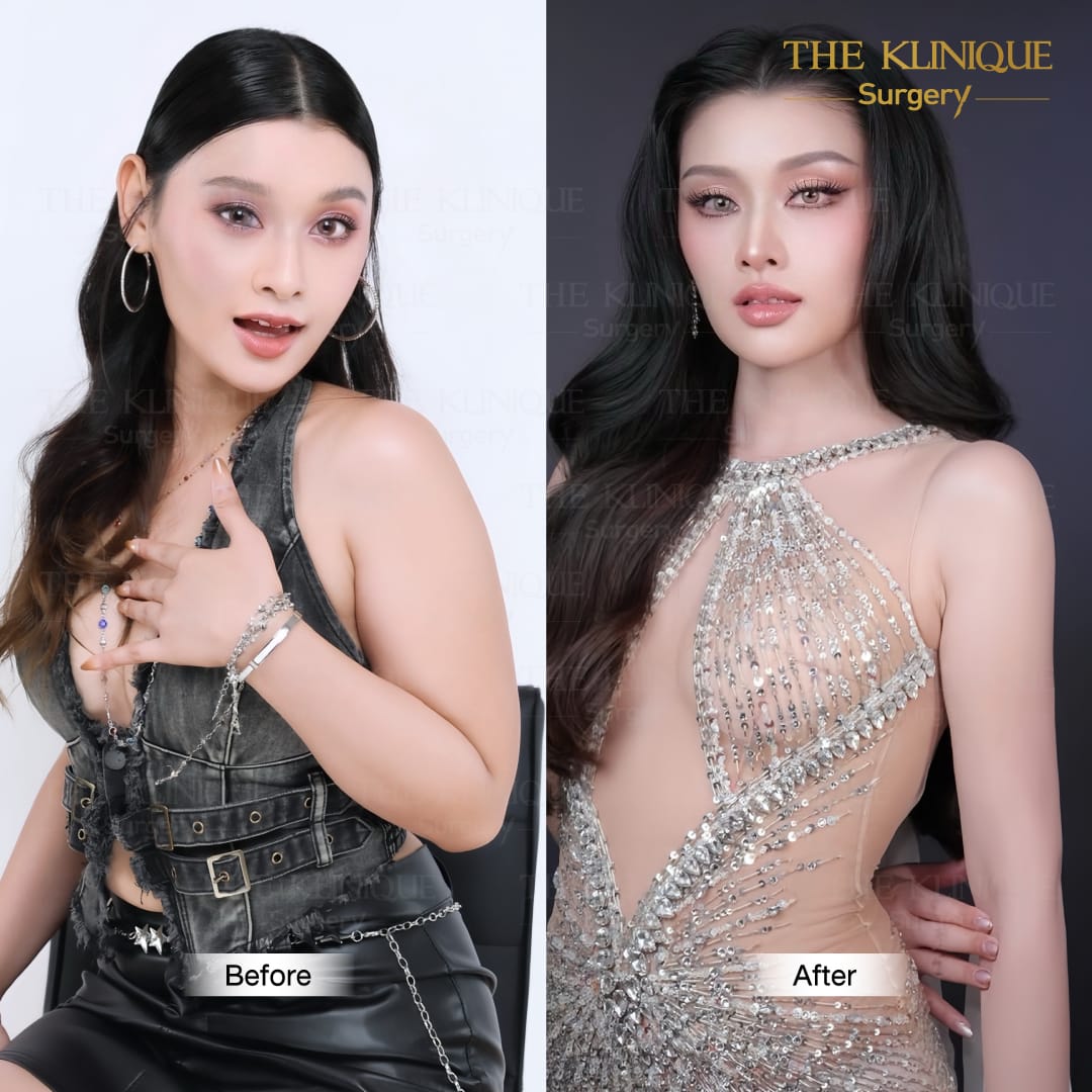 Liposuction, Sculpting,Xshape,Lipo, ศัลยกรรมดูดไขมัน, ดูดไขมัน,คลินิกดูดไขมัน,ดูดไขมันเฉพาะส่วน,ดูดไขมันเหนียง,ดูดไขมันหน้าท้อง,ดูดไขมันรีวิว, รีวิวดูดไขมัน, รีวิวดูดไขมันหน้าท้อง,ดูดไขมันต้นแขน, ดูดไขมันต้นขา,ดูดไขมันน่อง, ลดความอ้วน, ดูดไขมันที่ไหนดี, ดูดไขมันราคา, ดูดไขมันทั้งตัว, รีวิว ดูดไขมันต้นขา, ดูดไขมันขา