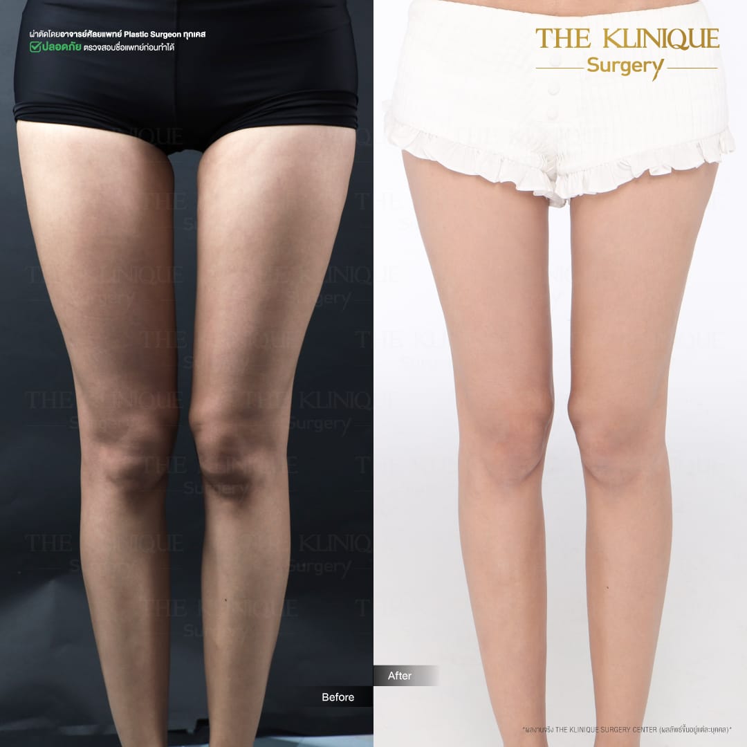 review-maprang-BellyLiposuction