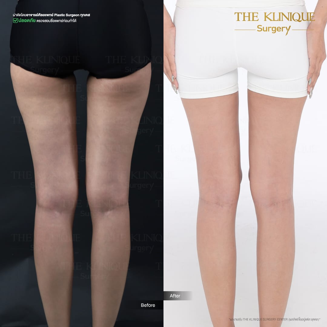 review-maprang-BellyLiposuction