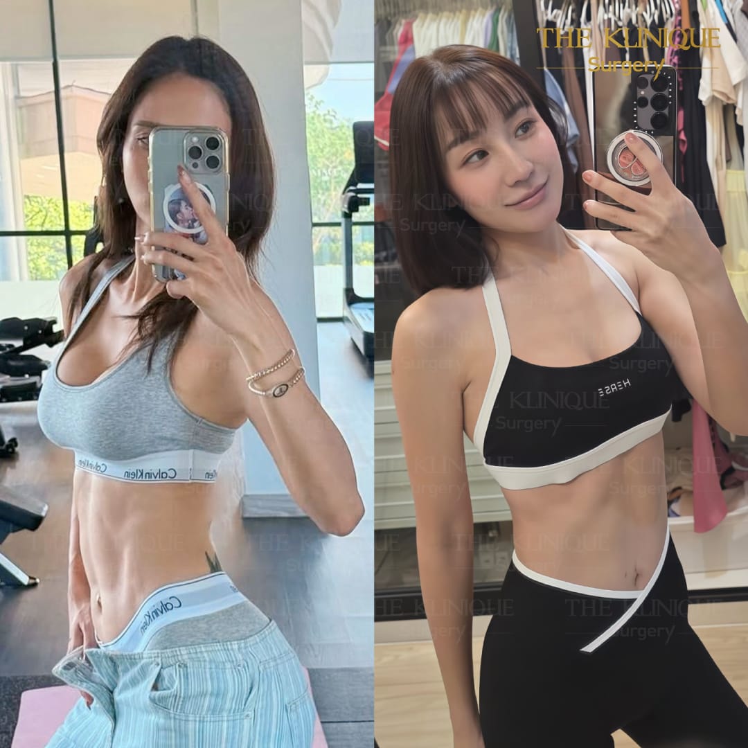 Liposuction, Sculpting,Xshape,Lipo, ศัลยกรรมดูดไขมัน, ดูดไขมัน,คลินิกดูดไขมัน,ดูดไขมันเฉพาะส่วน,ดูดไขมันเหนียง,ดูดไขมันหน้าท้อง,รีวิวดูดไขมัน, รีวิวดูดไขมันหน้าท้อง,ดูดไขมันต้นแขน, ดูดไขมันต้นขา,ลดความอ้วน, ดูดไขมันที่ไหนดี, ดูดไขมันราคา