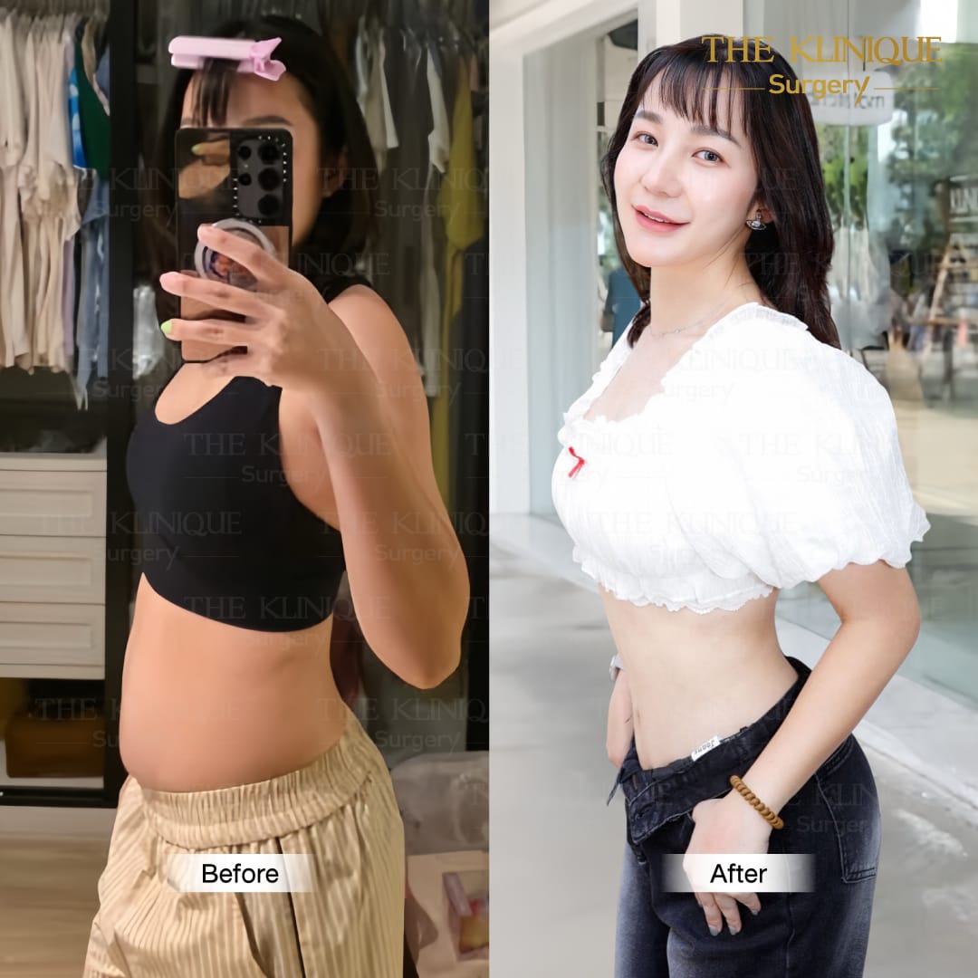 Liposuction, Sculpting,Xshape,Lipo, ศัลยกรรมดูดไขมัน, ดูดไขมัน,คลินิกดูดไขมัน,ดูดไขมันเฉพาะส่วน,ดูดไขมันเหนียง,ดูดไขมันหน้าท้อง,รีวิวดูดไขมัน, รีวิวดูดไขมันหน้าท้อง,ดูดไขมันต้นแขน, ดูดไขมันต้นขา,ลดความอ้วน, ดูดไขมันที่ไหนดี, ดูดไขมันราคา