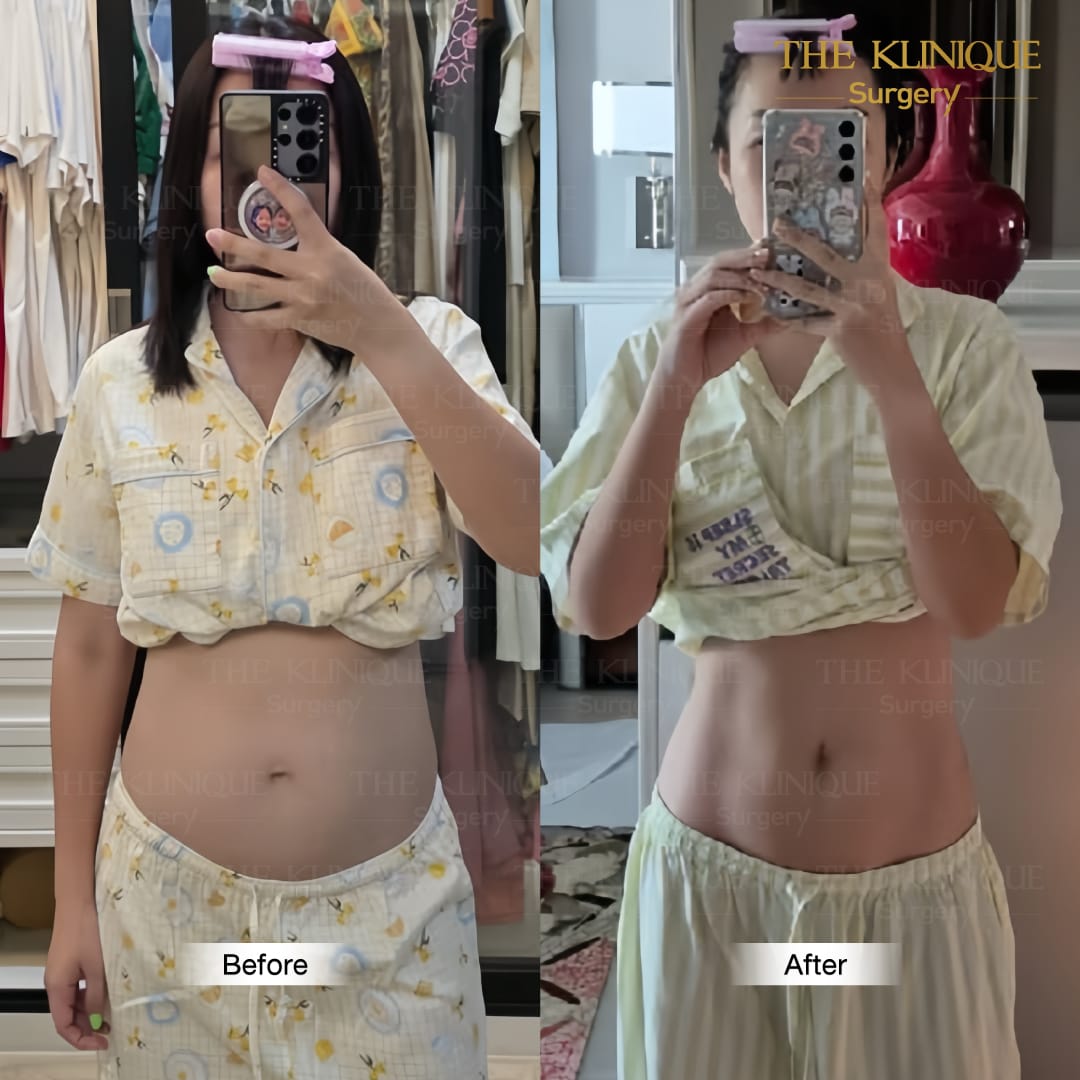 Liposuction, Sculpting,Xshape,Lipo, ศัลยกรรมดูดไขมัน, ดูดไขมัน,คลินิกดูดไขมัน,ดูดไขมันเฉพาะส่วน,ดูดไขมันเหนียง,ดูดไขมันหน้าท้อง,รีวิวดูดไขมัน, รีวิวดูดไขมันหน้าท้อง,ดูดไขมันต้นแขน, ดูดไขมันต้นขา,ลดความอ้วน, ดูดไขมันที่ไหนดี, ดูดไขมันราคา